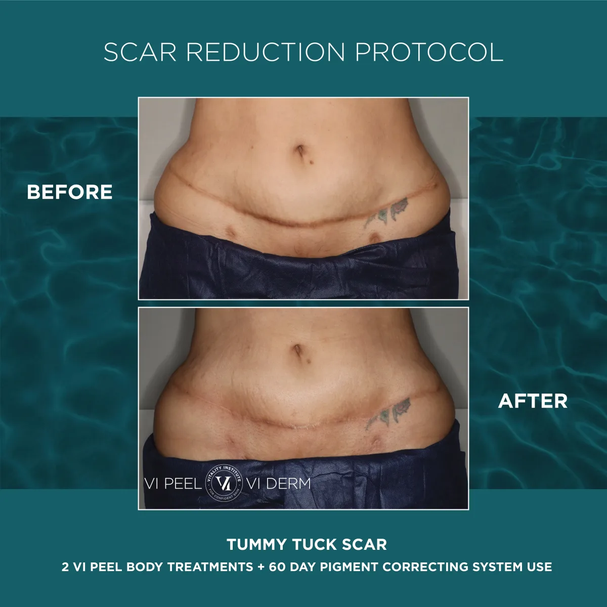 Tummy tuck scar before and after 2 VI Peel Body + 60 Day Pigment Correcting System