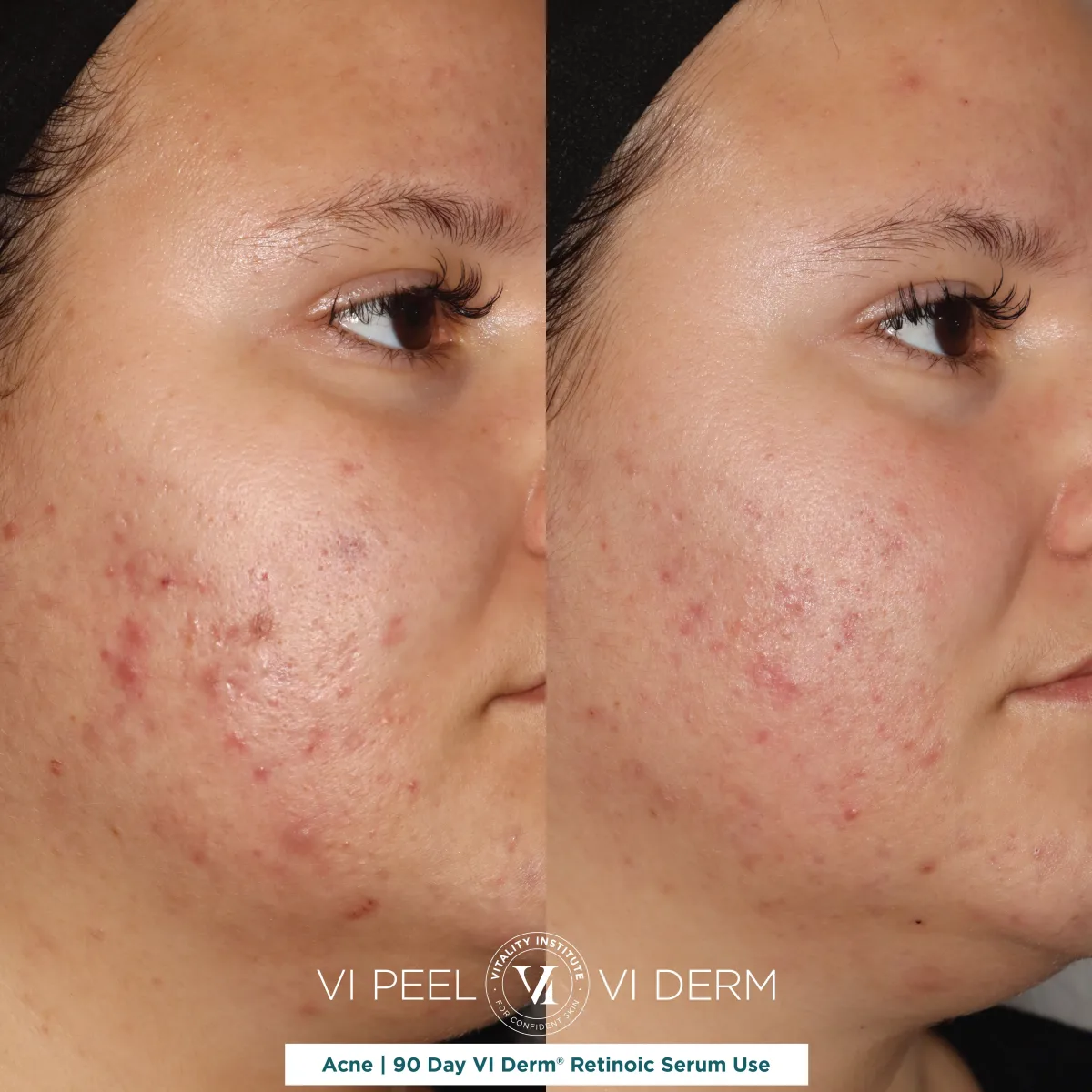 Acne before and after 90 days VI Derm Retinoic Serum