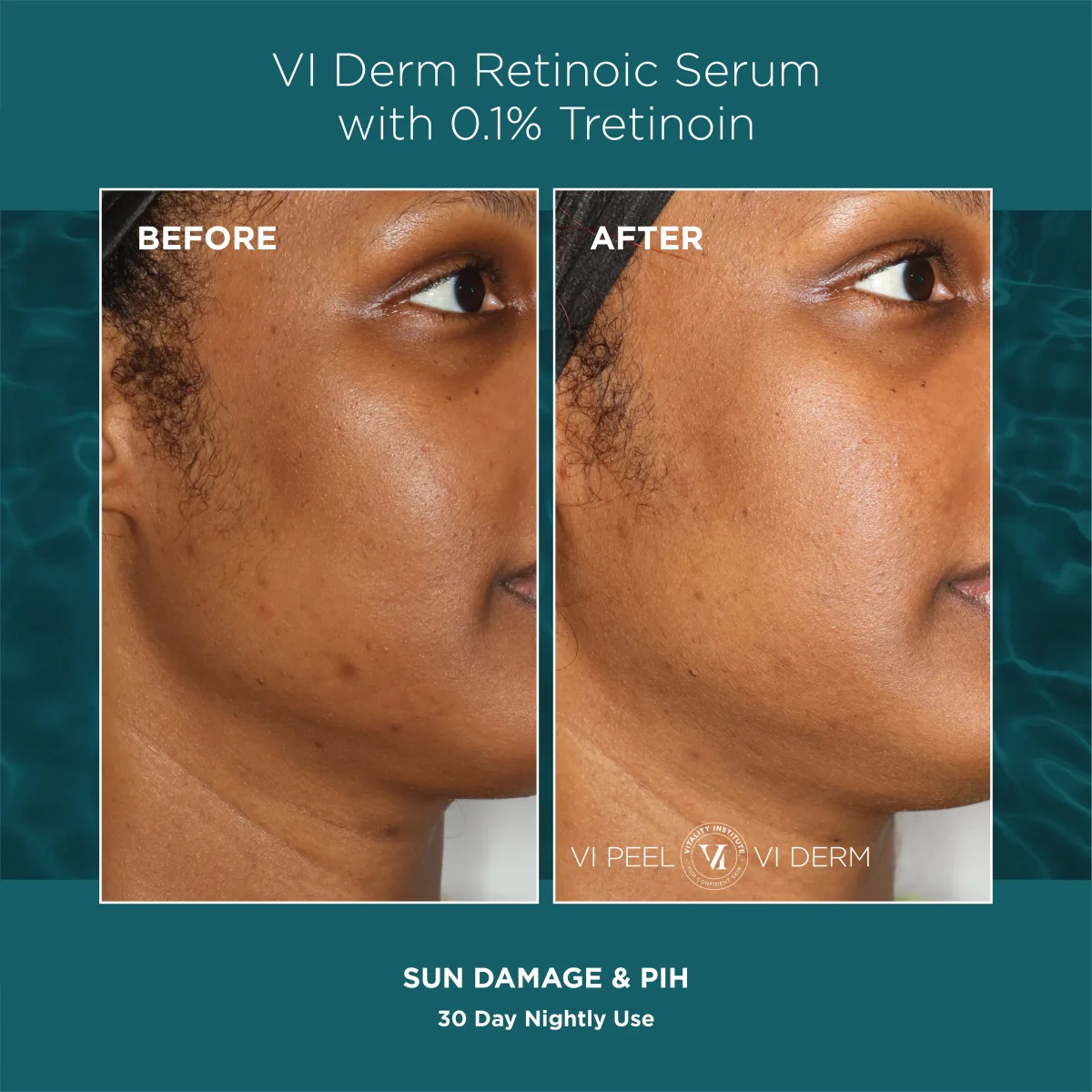 Sun damage and PIH on deep skin tone before and after VI Derm Retinoic Serum — 30 days