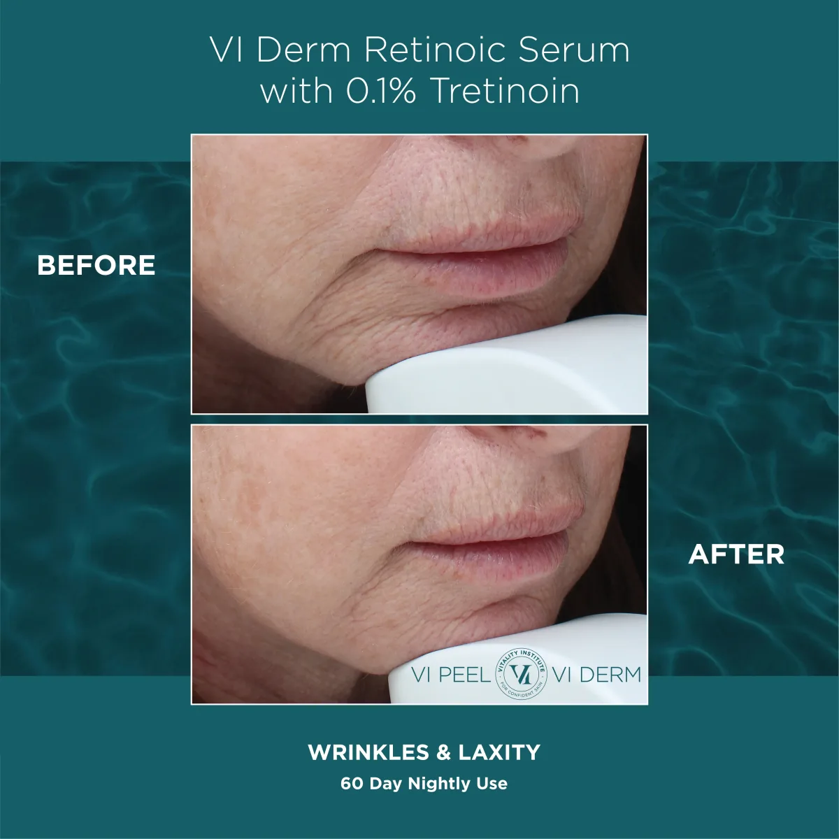 Perioral wrinkles and laxity before and after VI Derm Retinoic Serum 0.1% Tretinoin — 60 nights