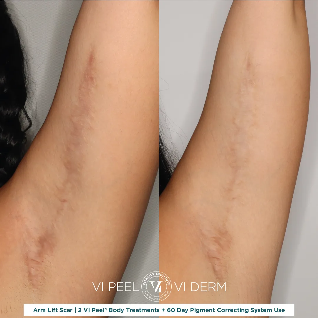 Arm lift surgical scar left arm before and after 2 VI Peel Body + 60 Day Pigment Correcting System