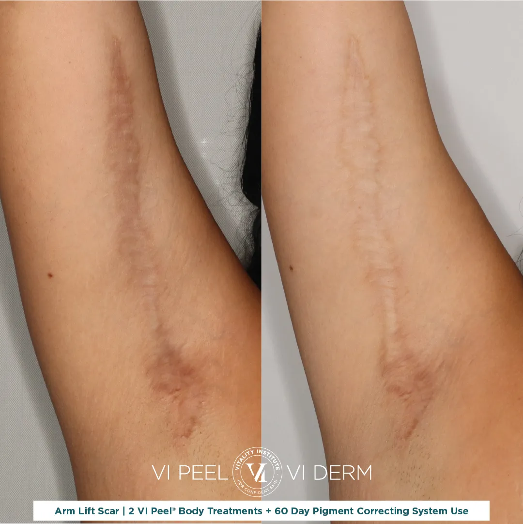 Arm lift surgical scar right arm before and after 2 VI Peel Body + 60 Day Pigment Correcting System