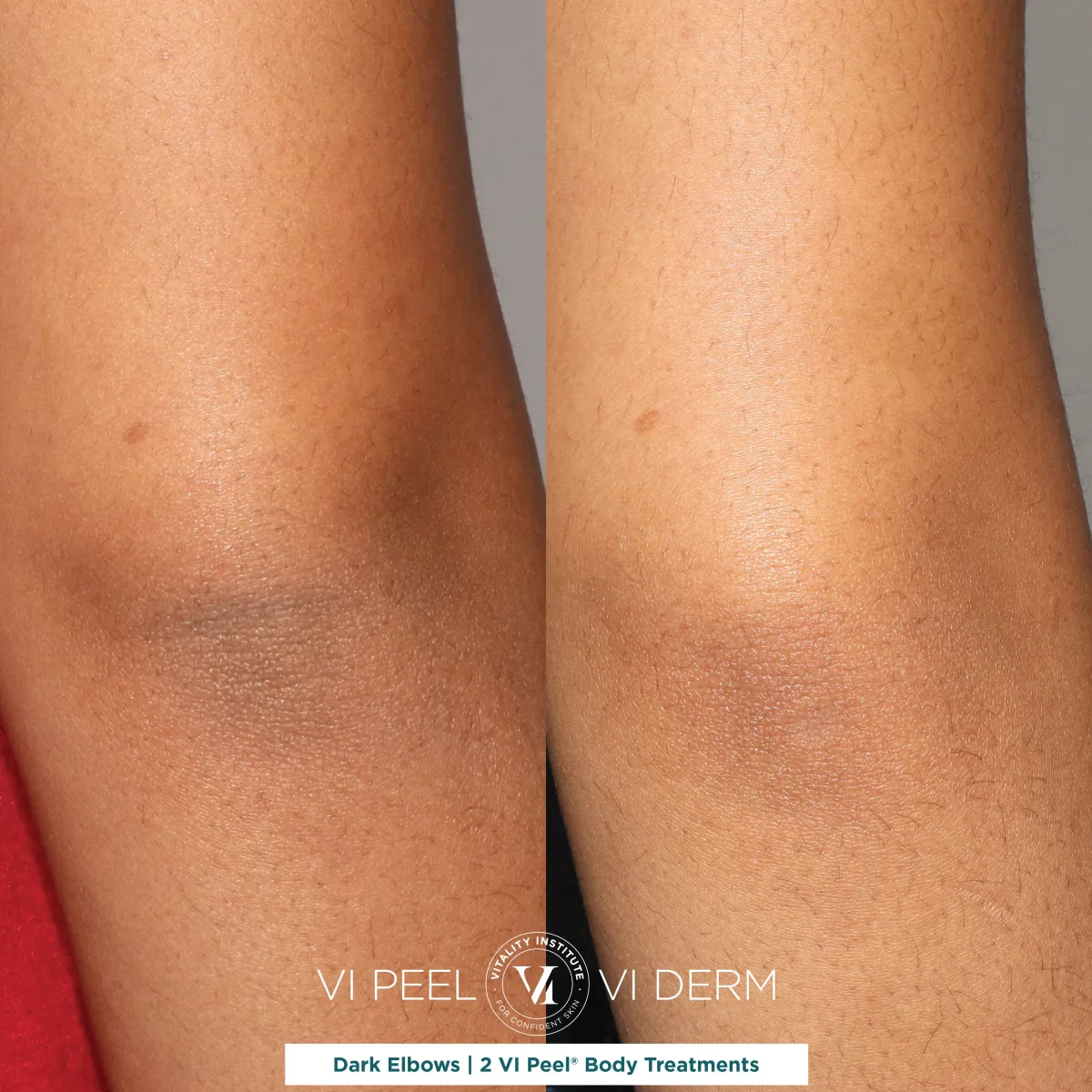 Dark elbows on deep skin tone before and after 2 VI Peel Body treatments