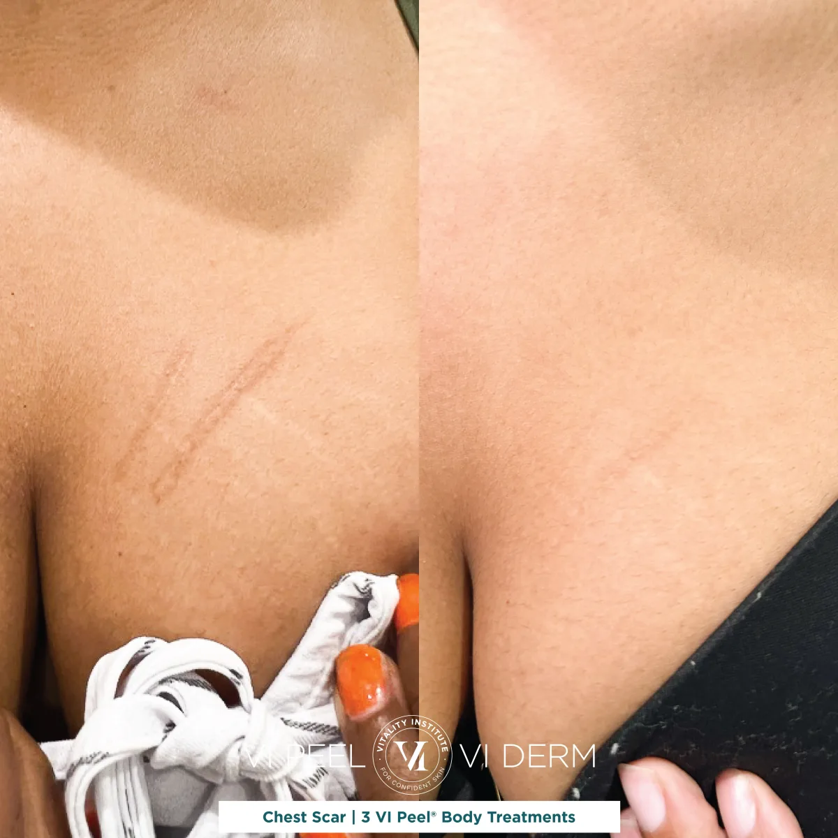 Chest scar before and after 3 VI Peel Body treatments