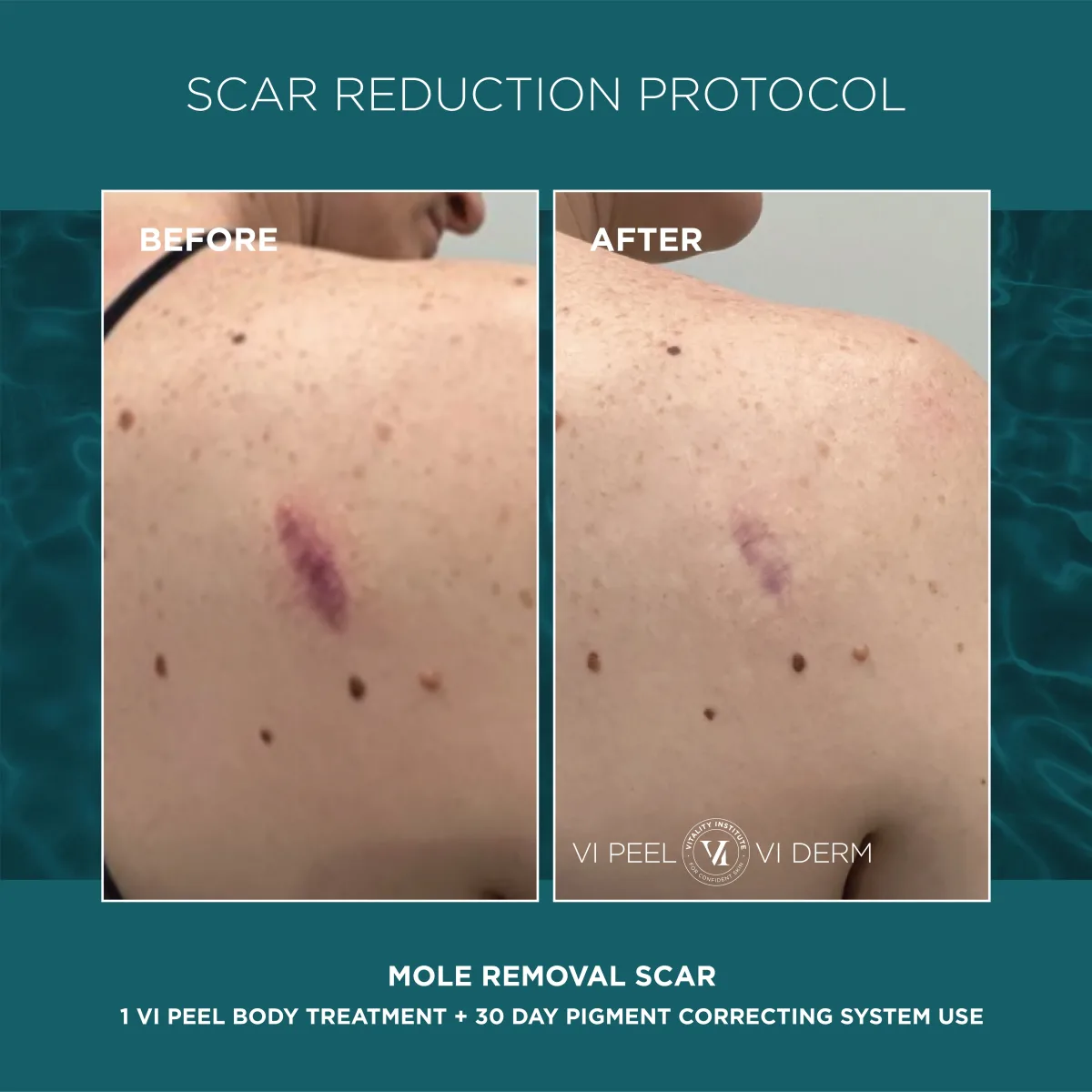 Mole removal scar on upper back before and after 1 VI Peel Body + 30 Day Pigment Correcting System