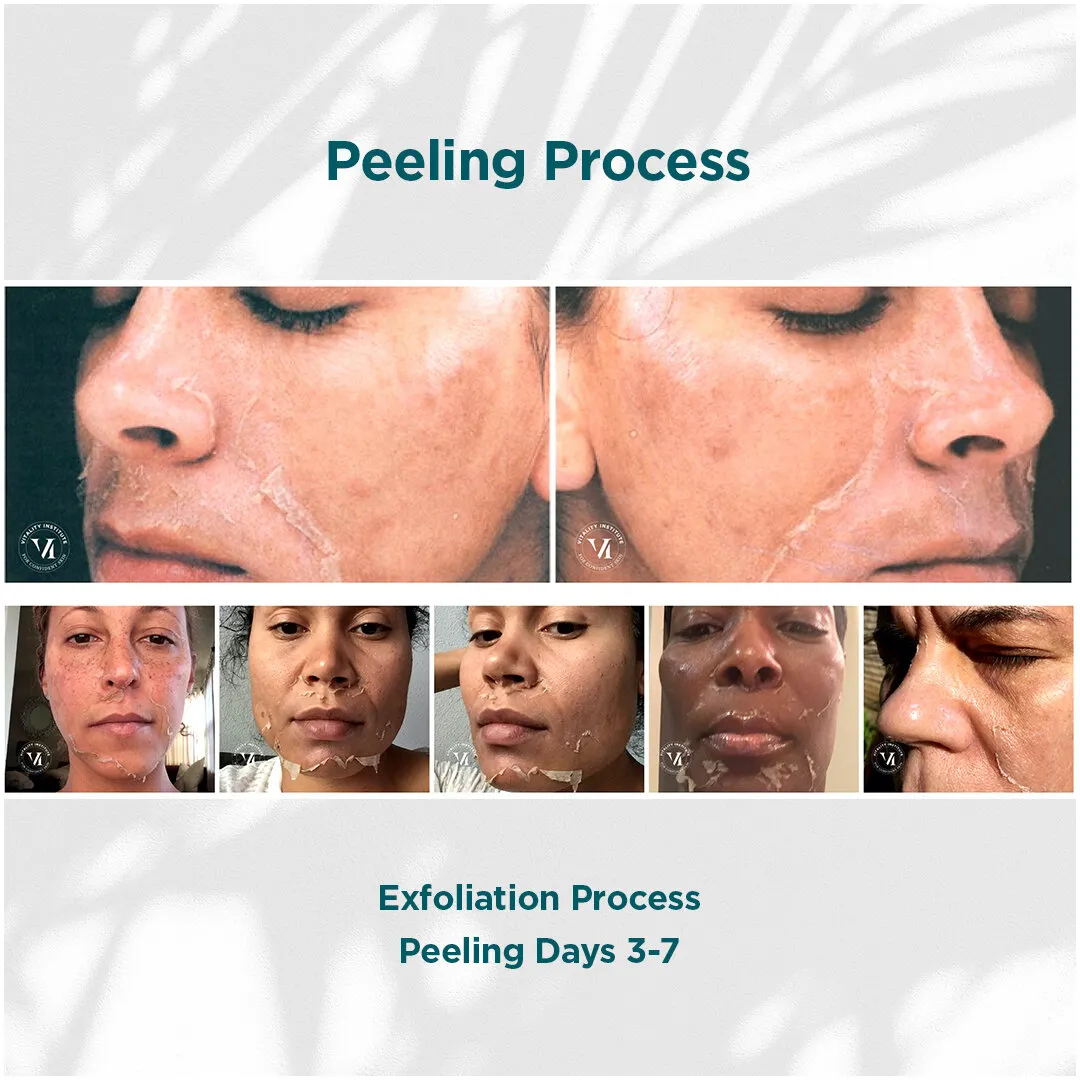 Hyperpigmentation, PIH and acne scars on deep skin tone before and after 3 series VI Peel Advanced + Precision Plus