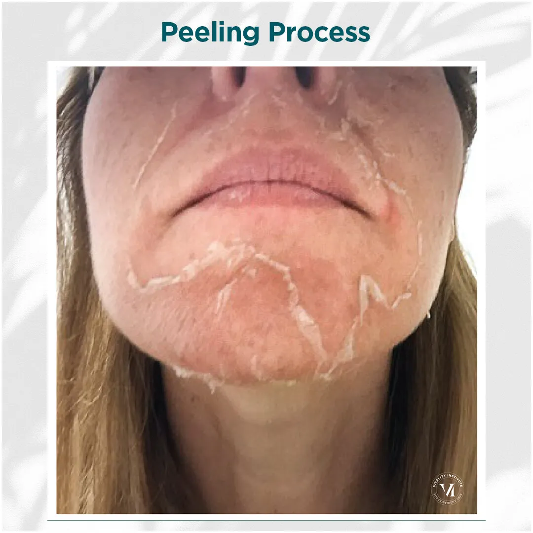 VI Peel peeling process on lower face and chin, days 3 through 7