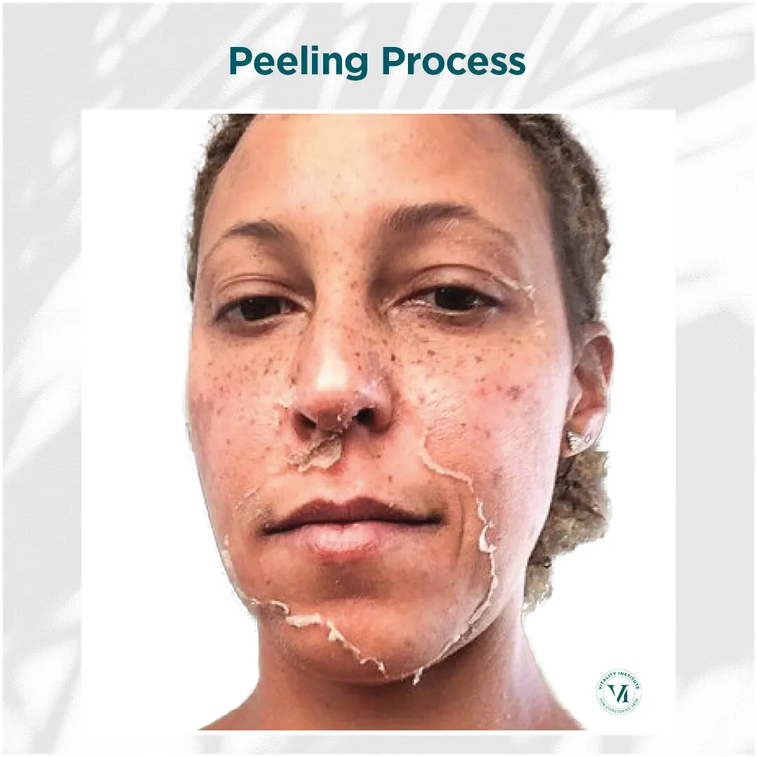 VI Peel peeling process on medium skin tone with freckles, days 3 through 7