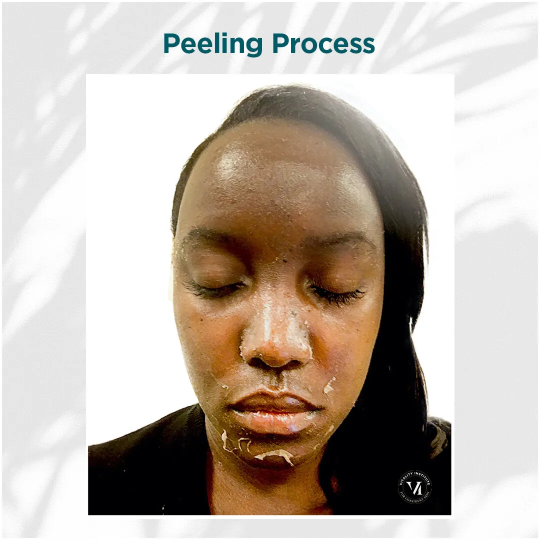 VI Peel peeling process on deep skin tone, days 3 through 7