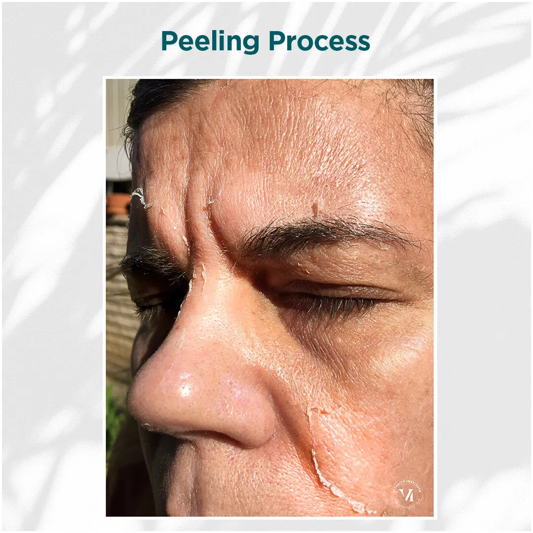 VI Peel peeling process on male client forehead and eye area, days 3 through 7