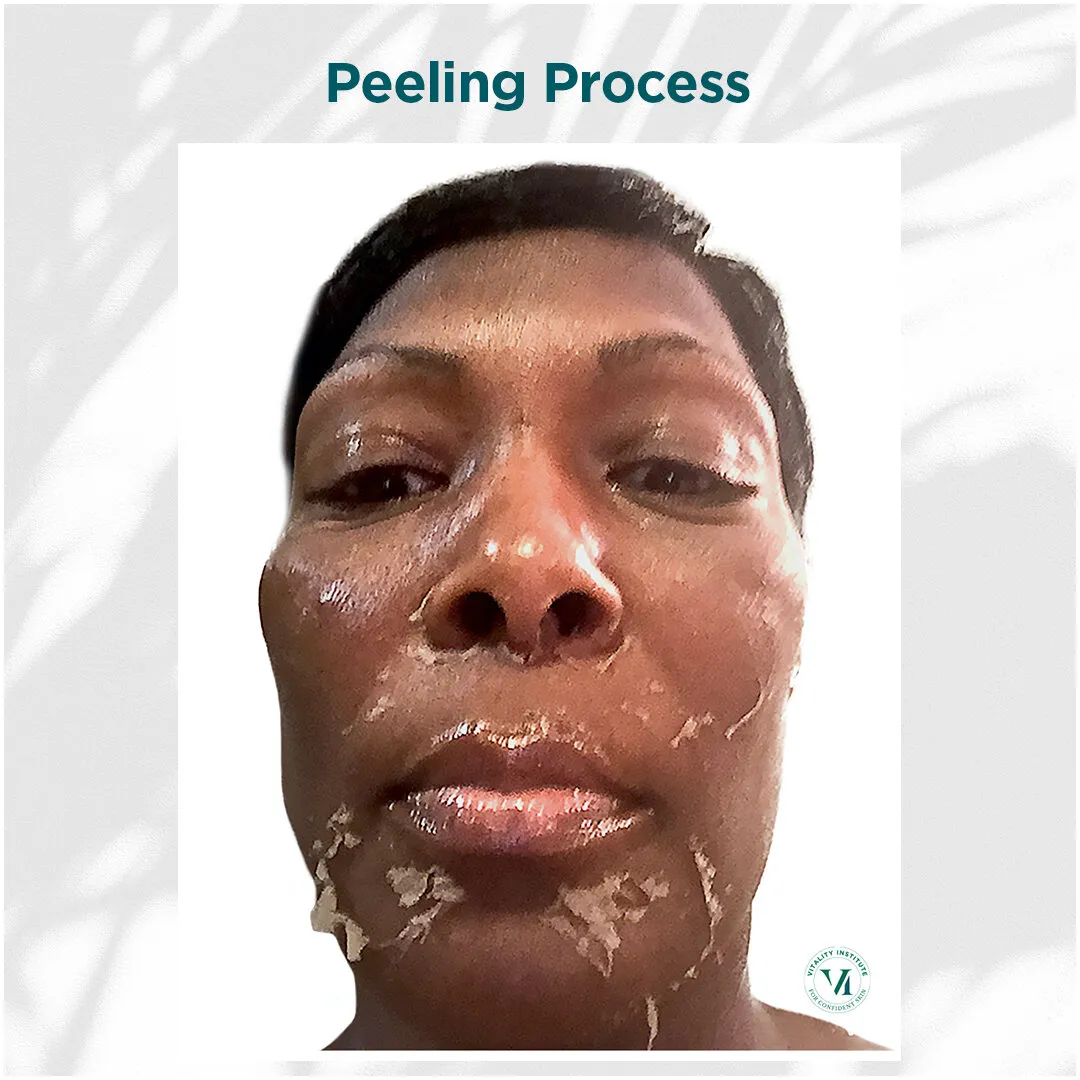 VI Peel peeling process on deep skin tone full face, days 3 through 7
