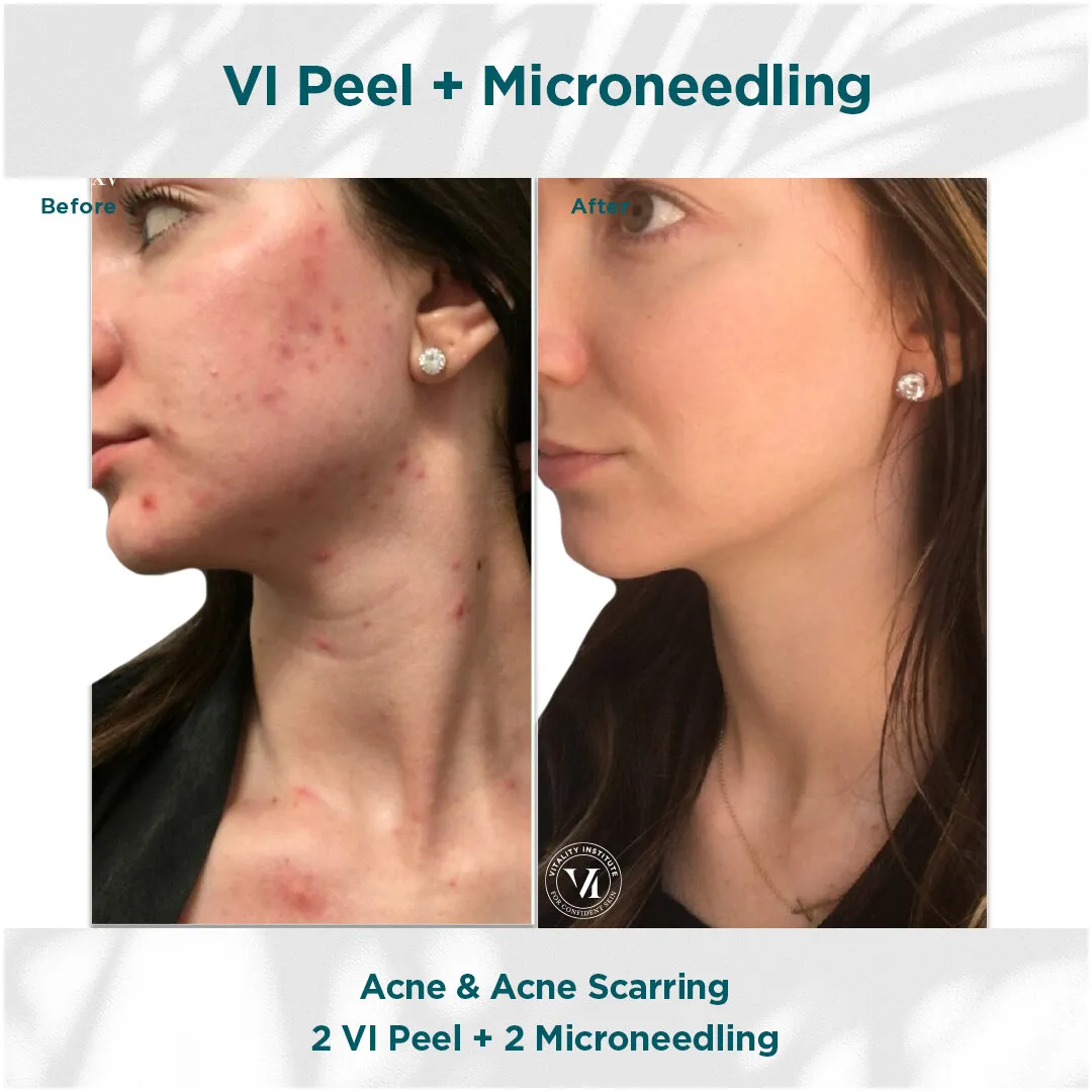 Acne and acne scarring before and after 2 VI Peel + 2 Micro Channeling