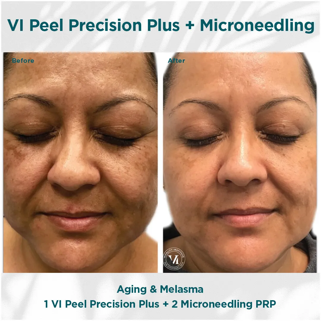 Aging and melasma before and after VI Peel Precision Plus + Micro Channeling PRP