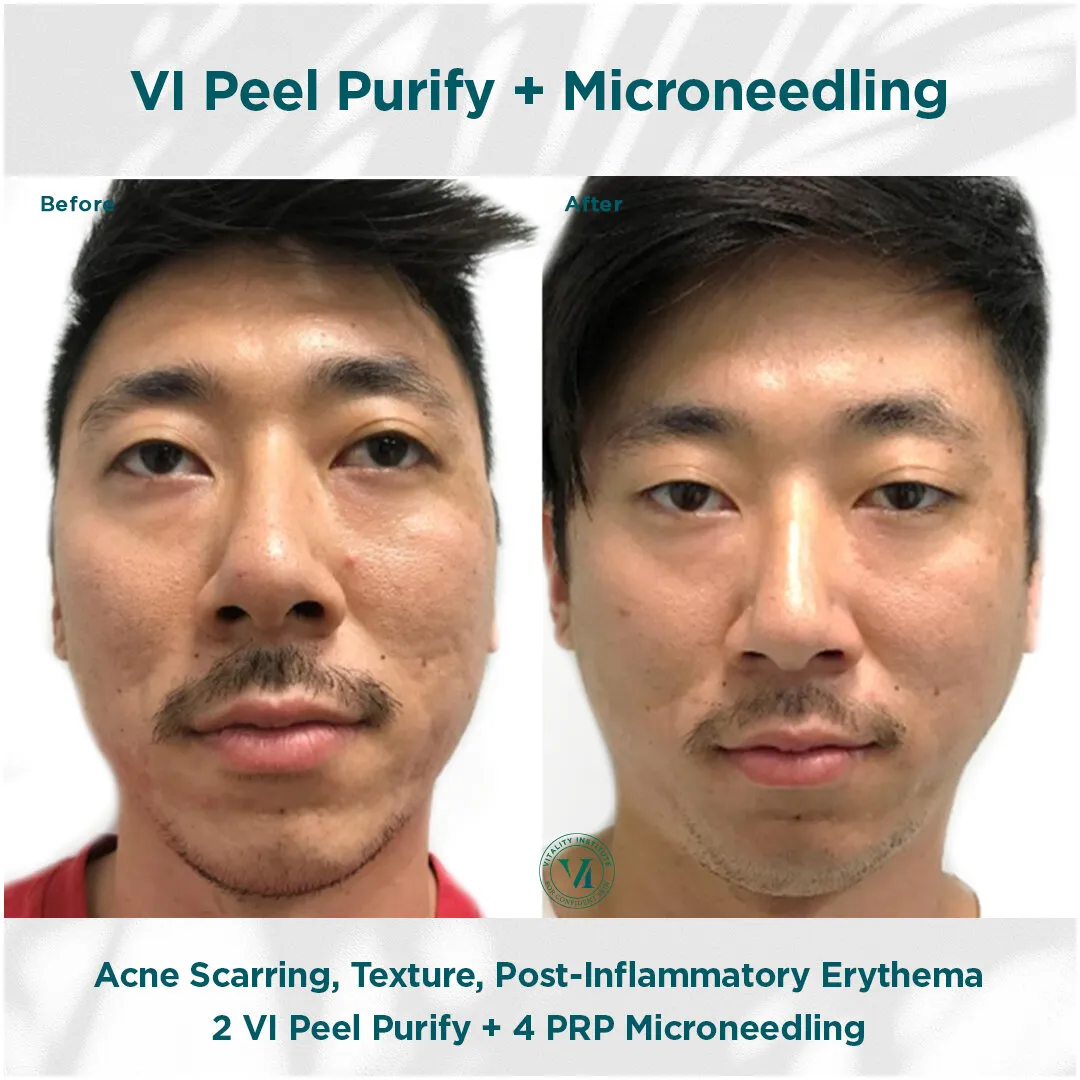 Male acne scarring, texture and post-inflammatory erythema before and after VI Peel Purify + PRP Micro Channeling