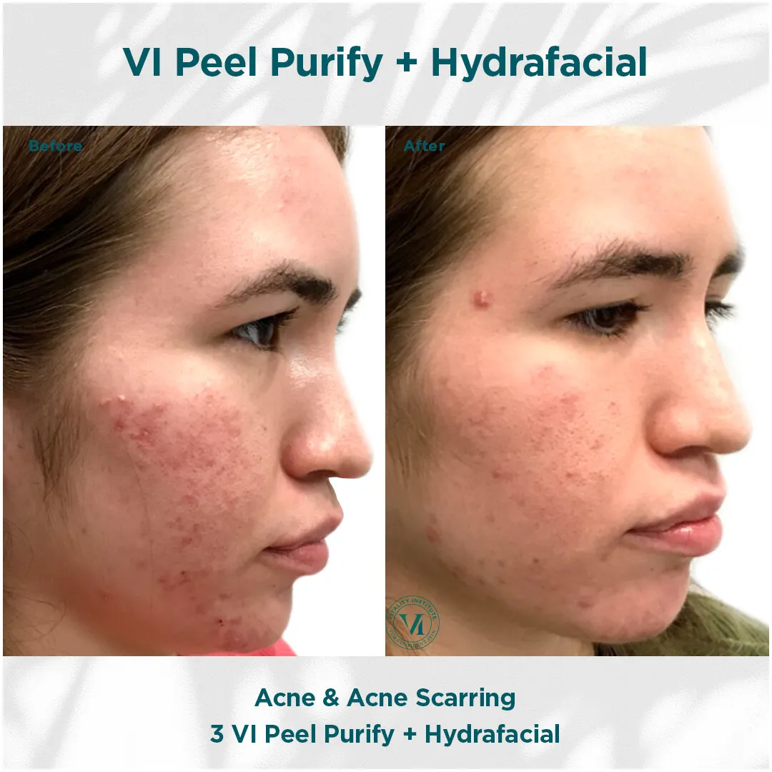 Acne and acne scarring before and after 3 VI Peel Purify + Hydrafacial sessions