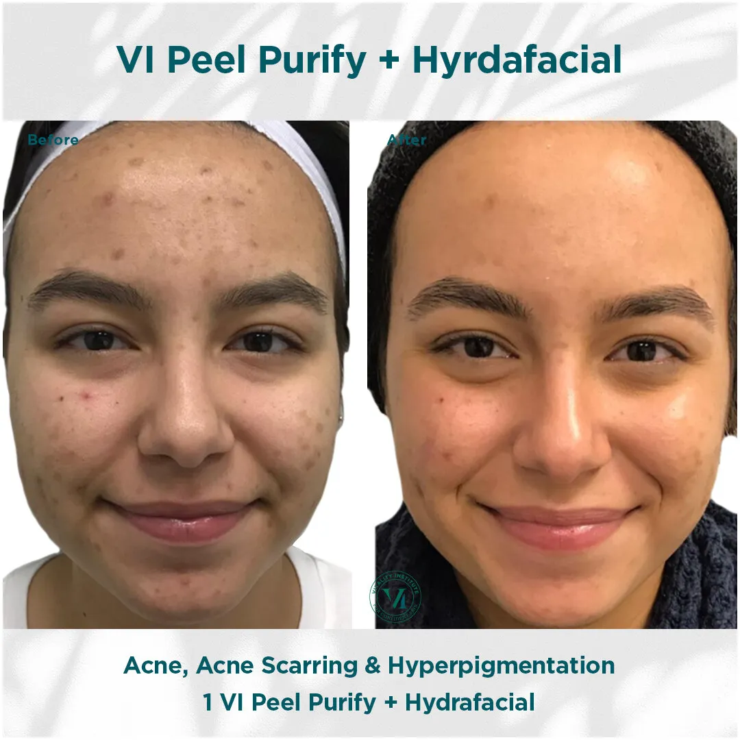 Acne, acne scarring and hyperpigmentation before and after VI Peel Purify + Hydrafacial
