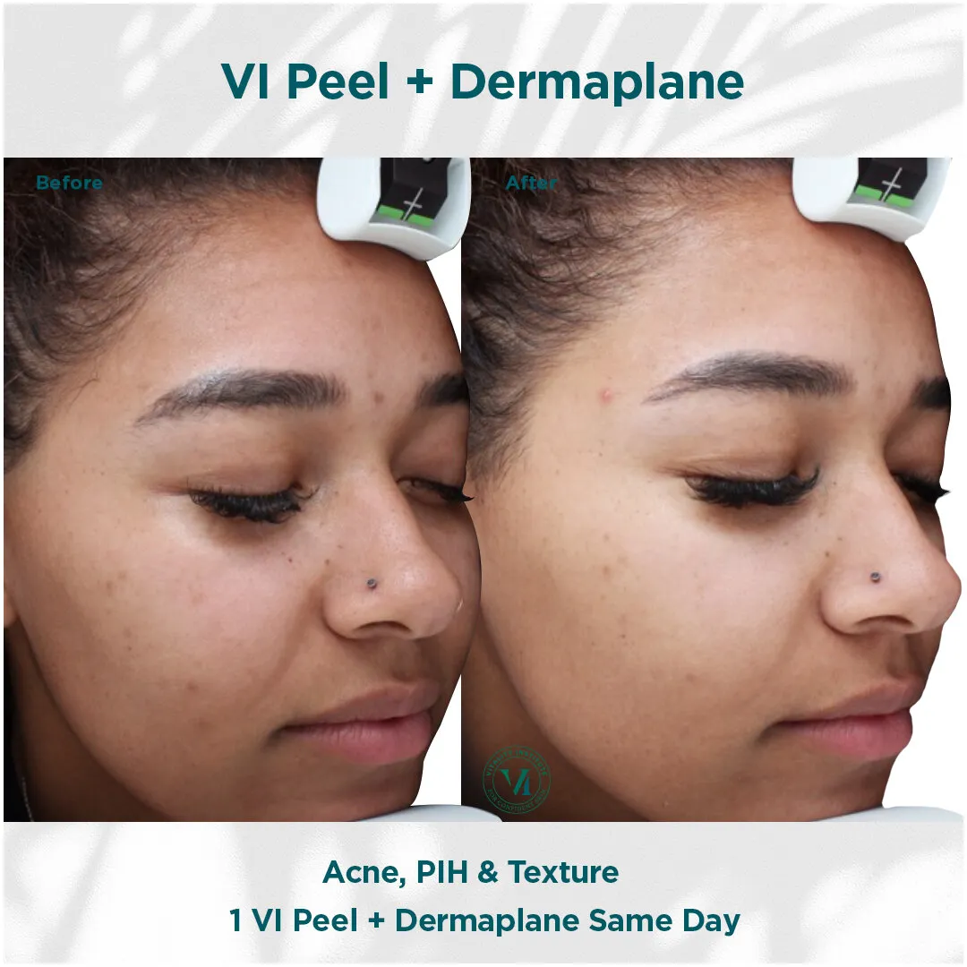 Acne, PIH and texture before and after VI Peel + Dermaplane same day