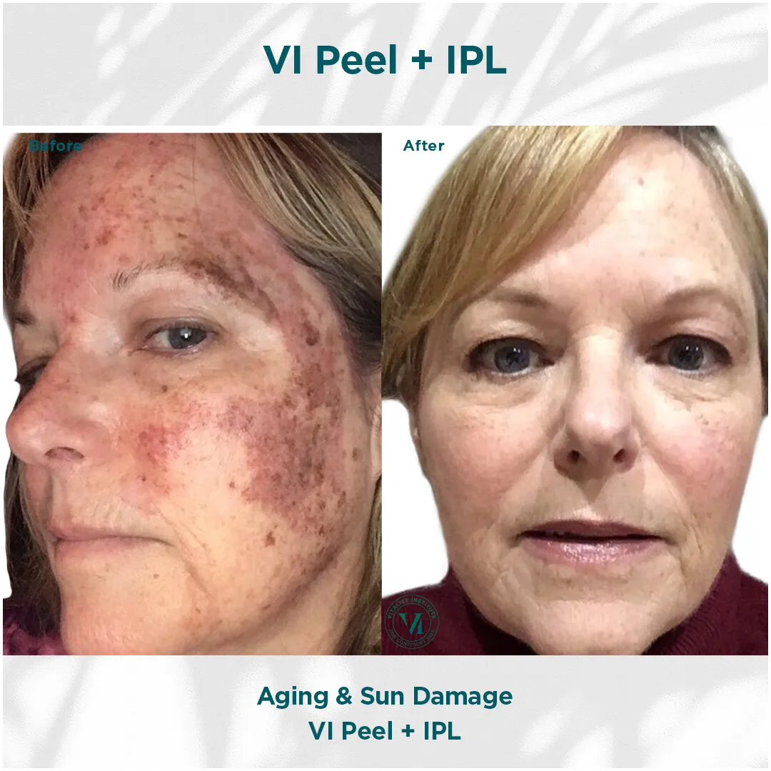 Aging and sun damage before and after VI Peel + IPL