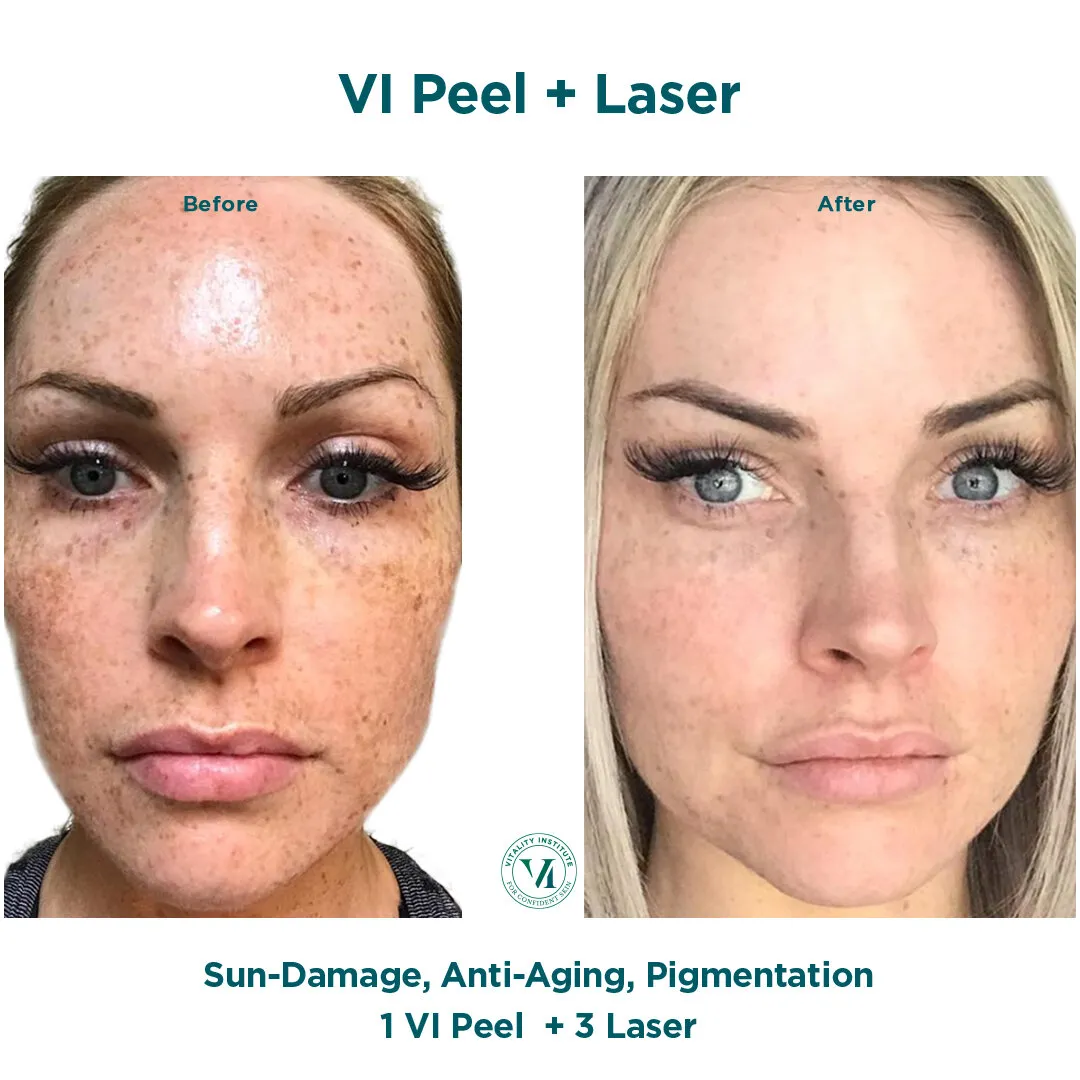 Sun damage, anti-aging and pigmentation before and after VI Peel + 3 Laser sessions