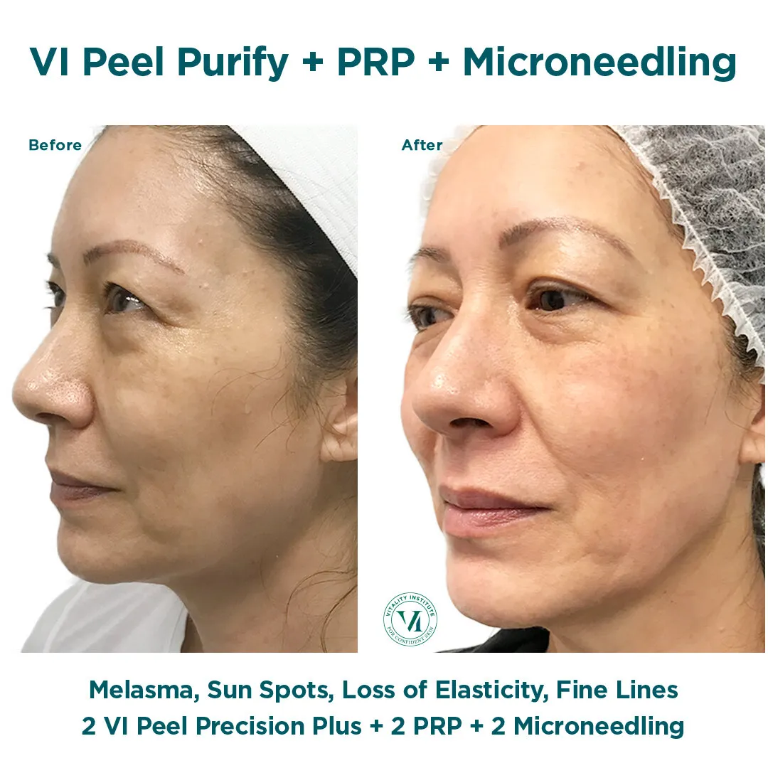 Melasma, sun spots and loss of elasticity before and after VI Peel + PRP + Micro Channeling
