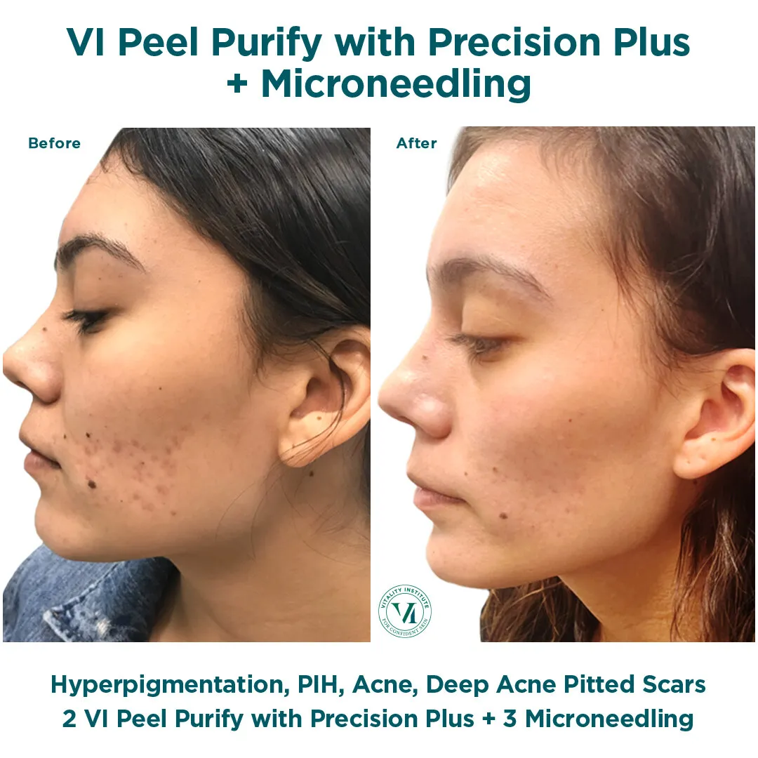 Hyperpigmentation, PIH and deep pitted acne scars before and after VI Peel Purify Precision Plus + Micro Channeling