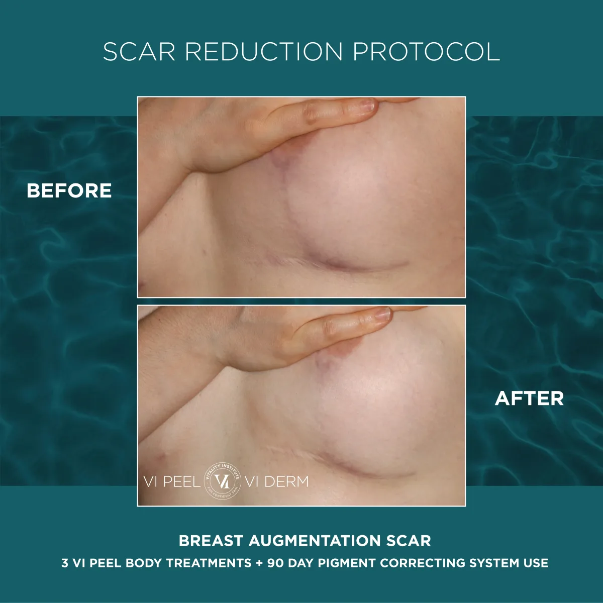 Breast augmentation scar lateral before and after 3 VI Peel Body + 90 Day Pigment Correcting System