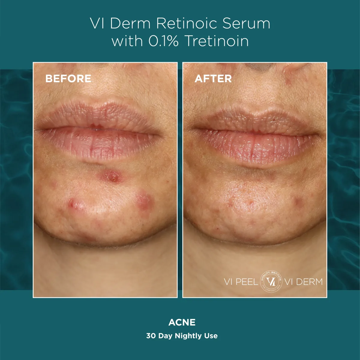 Chin acne before and after VI Derm Retinoic Serum 0.1% Tretinoin — 30 nights
