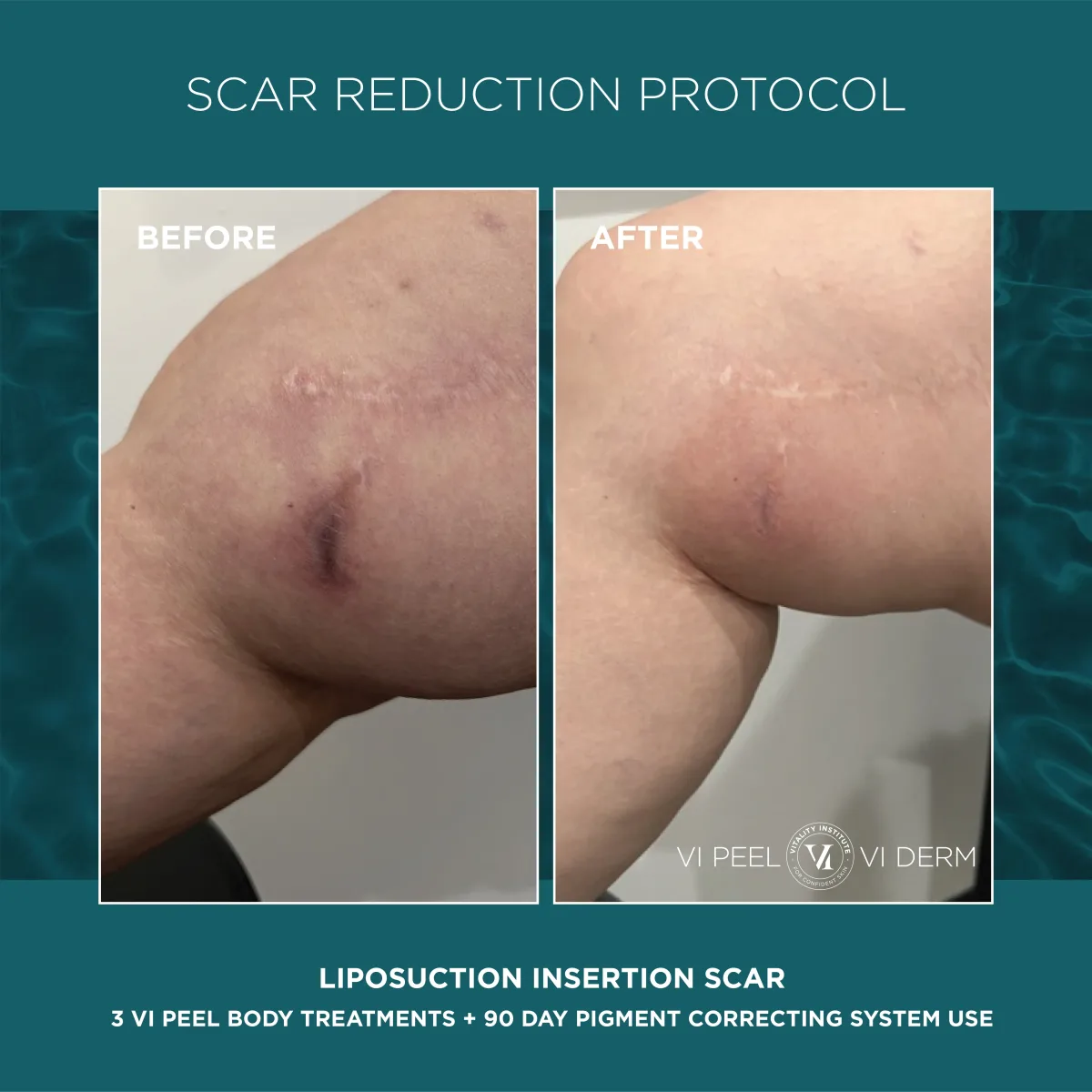 Liposuction insertion scar before and after 3 VI Peel Body + 90 Day Pigment Correcting System