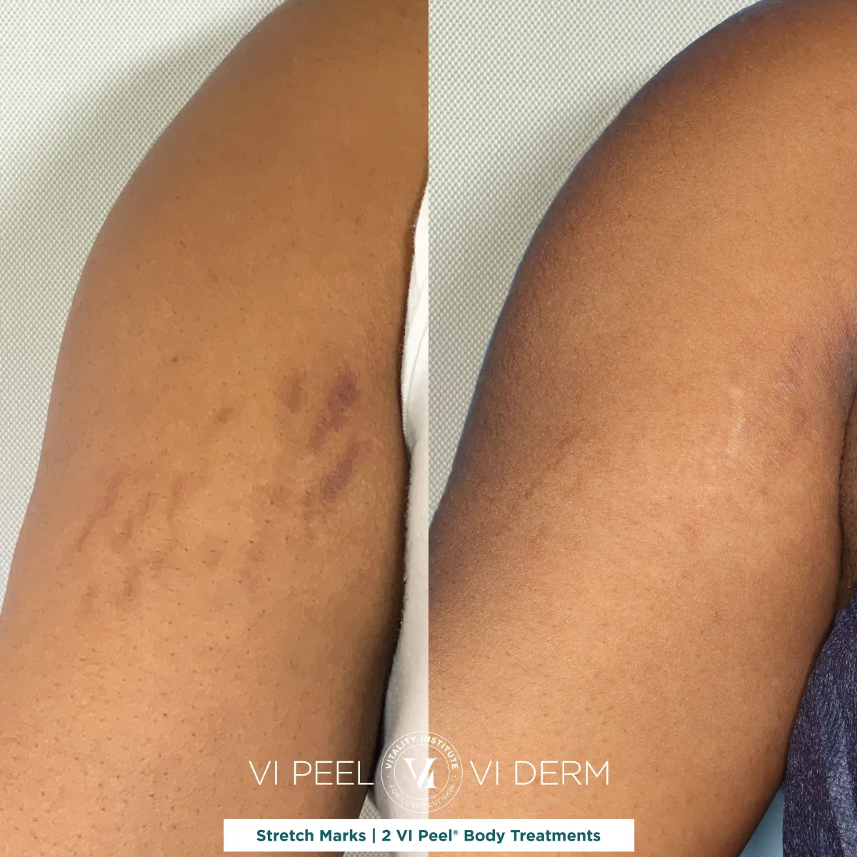 Arm stretch marks before and after 2 VI Peel Body treatments