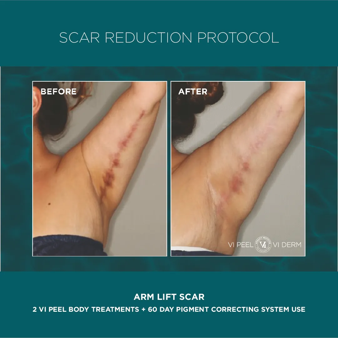 Arm lift surgical scar before and after 2 VI Peel Body + 60 Day Pigment Correcting System — branded graphic