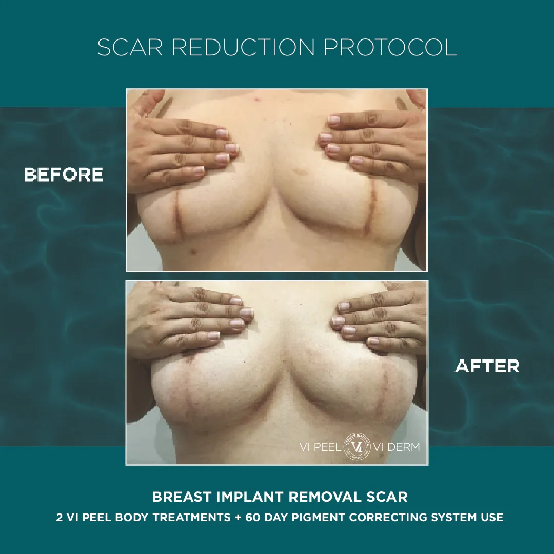 Breast implant removal scars before and after 2 VI Peel Body + 60 Day Pigment Correcting System