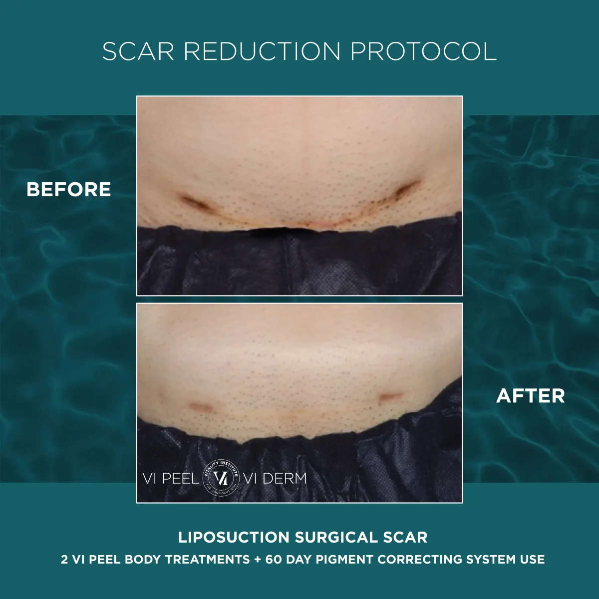 Liposuction surgical scar before and after 2 VI Peel Body + 60 Day Pigment Correcting System