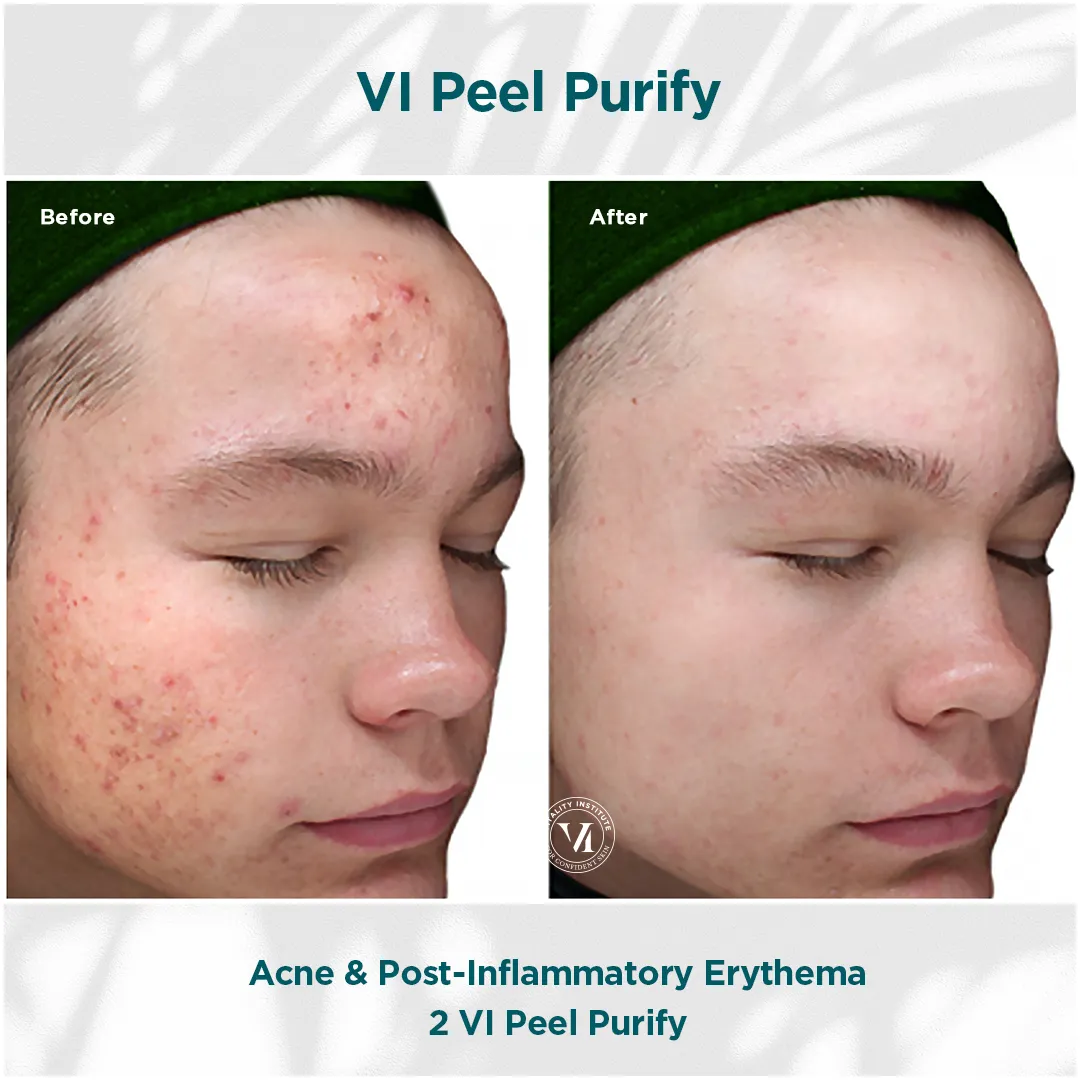 Acne and post-inflammatory erythema before and after 2 VI Peel Purify
