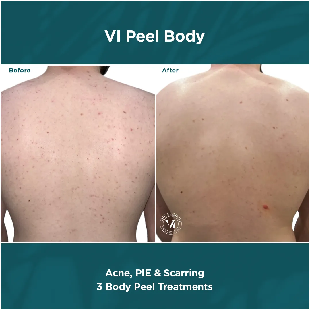 Male back acne, PIE and scarring before and after 3 VI Peel Body treatments