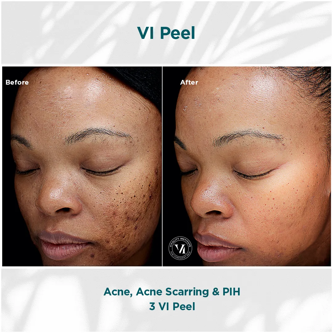 Melasma and fine lines 4-panel progression before and after 3 VI Peel Precision + Peptides
