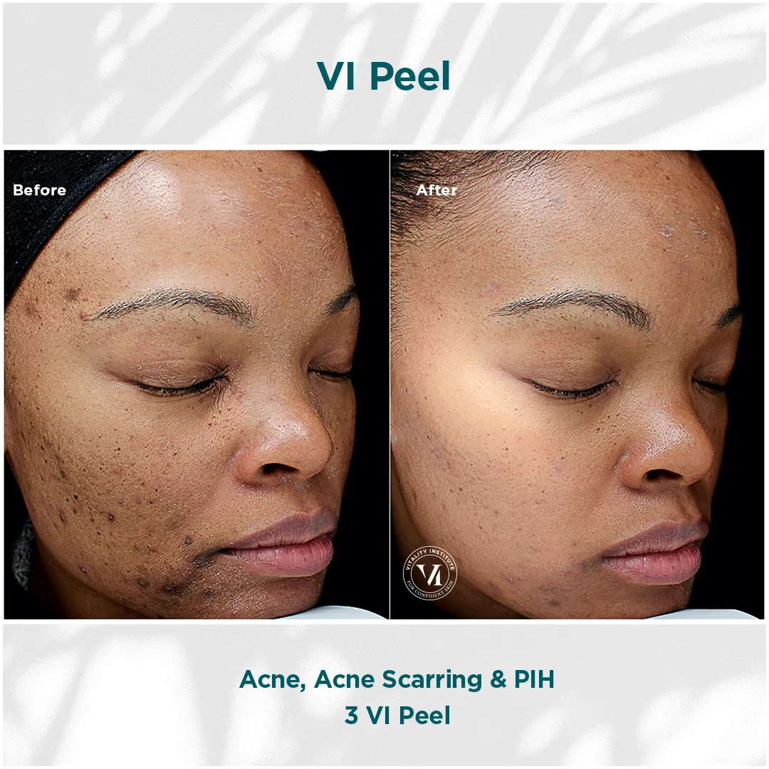 Acne, acne scarring and PIH on deep skin tone before and after 3 VI Peel