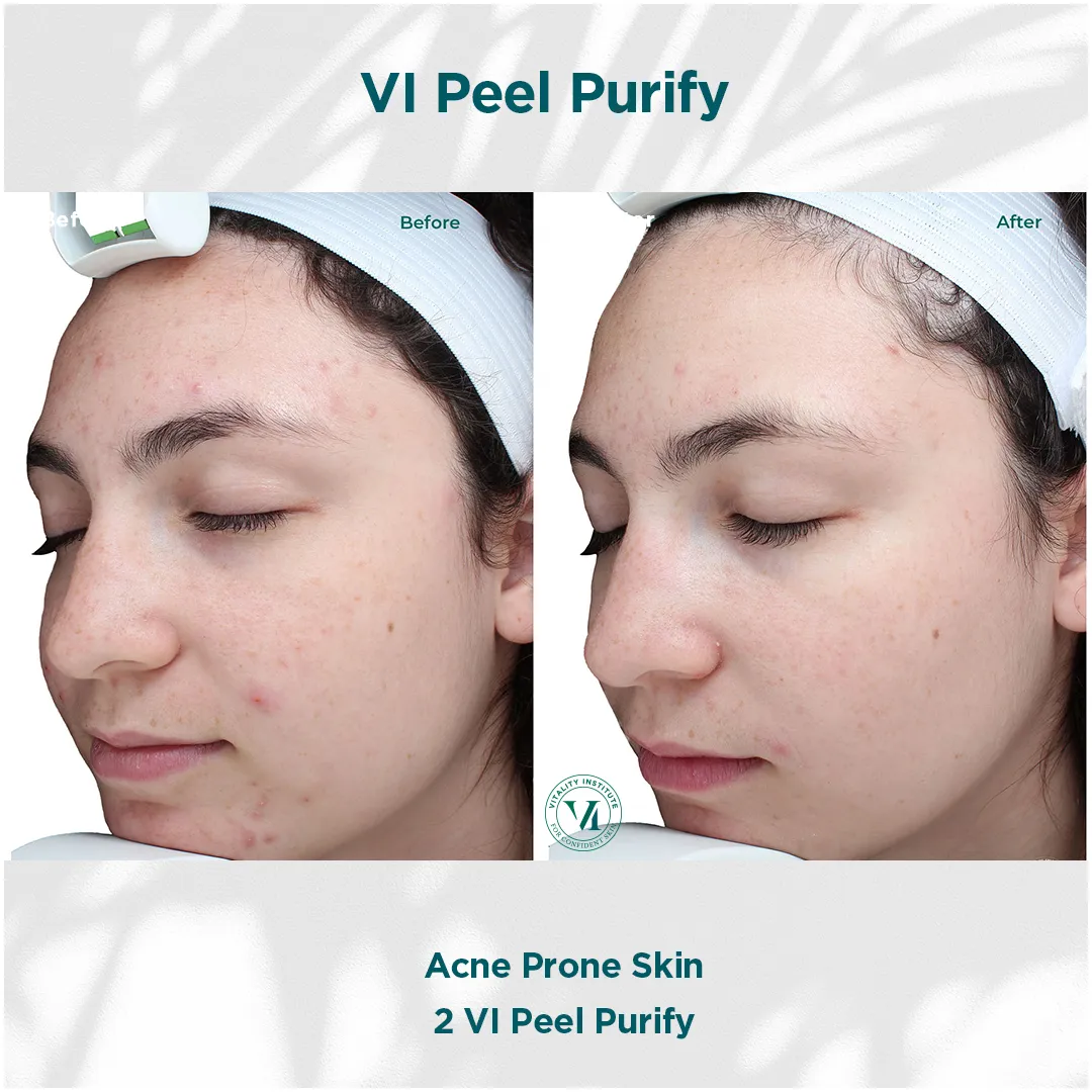 Acne prone skin before and after 2 VI Peel Purify