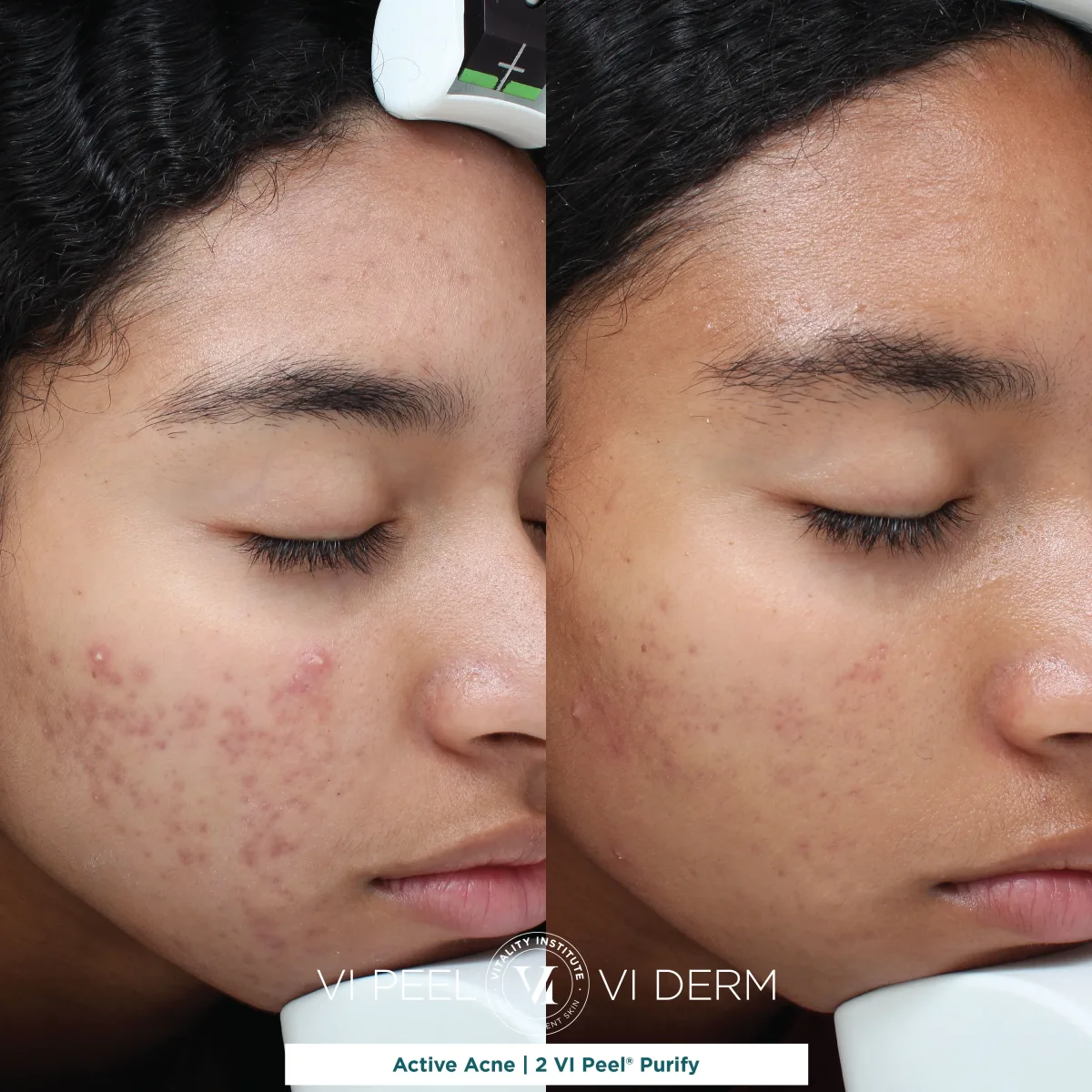 Active acne before and after 2 VI Peel Purify