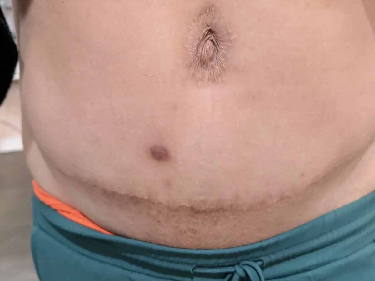 Abdomen after c-section scar revision