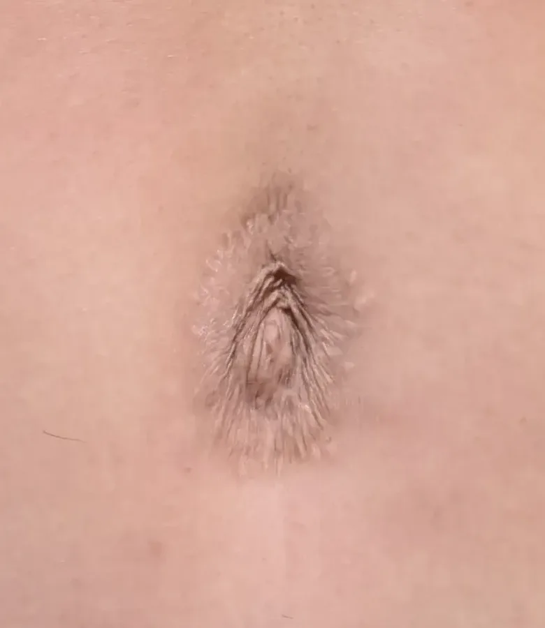 Abdomen after c-section scar revision