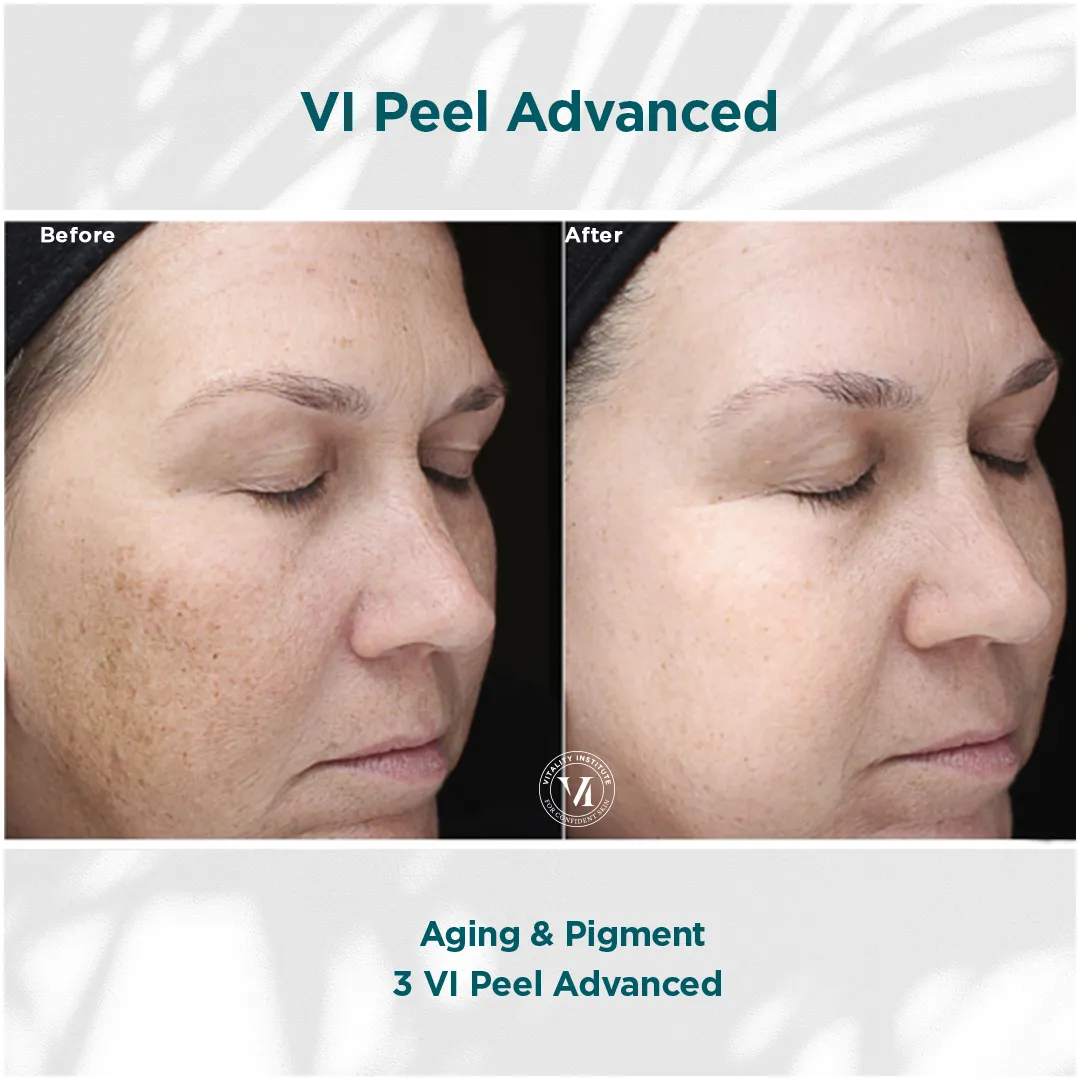 Facial aging and pigmentation before and after 3 VI Peel Advanced