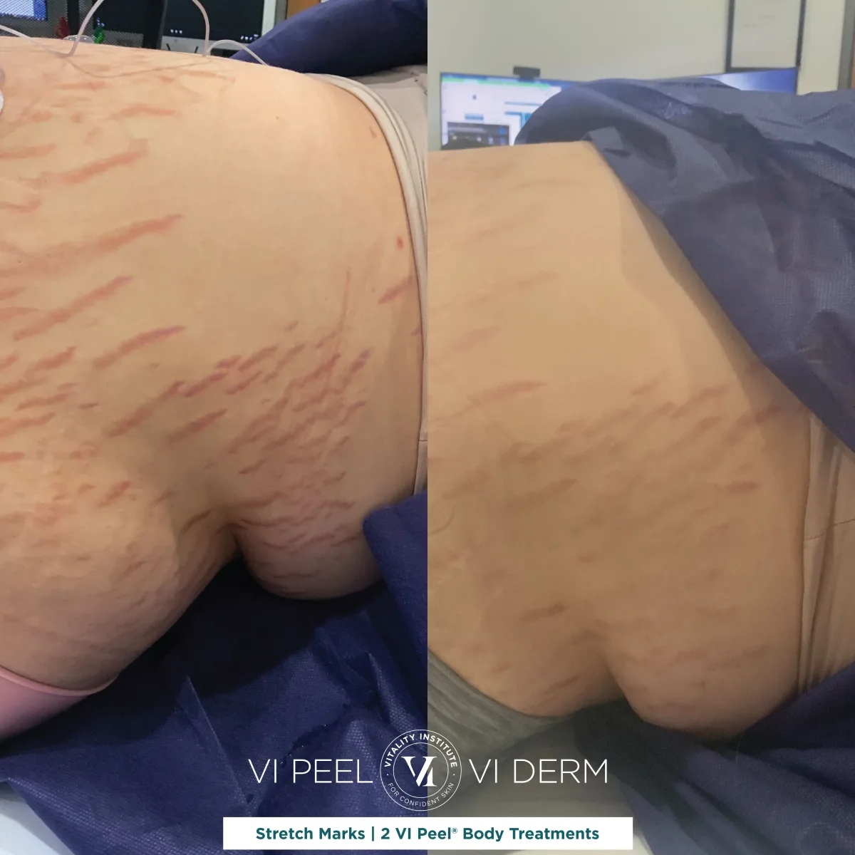 Abdominal stretch marks before and after 2 VI Peel Body treatments