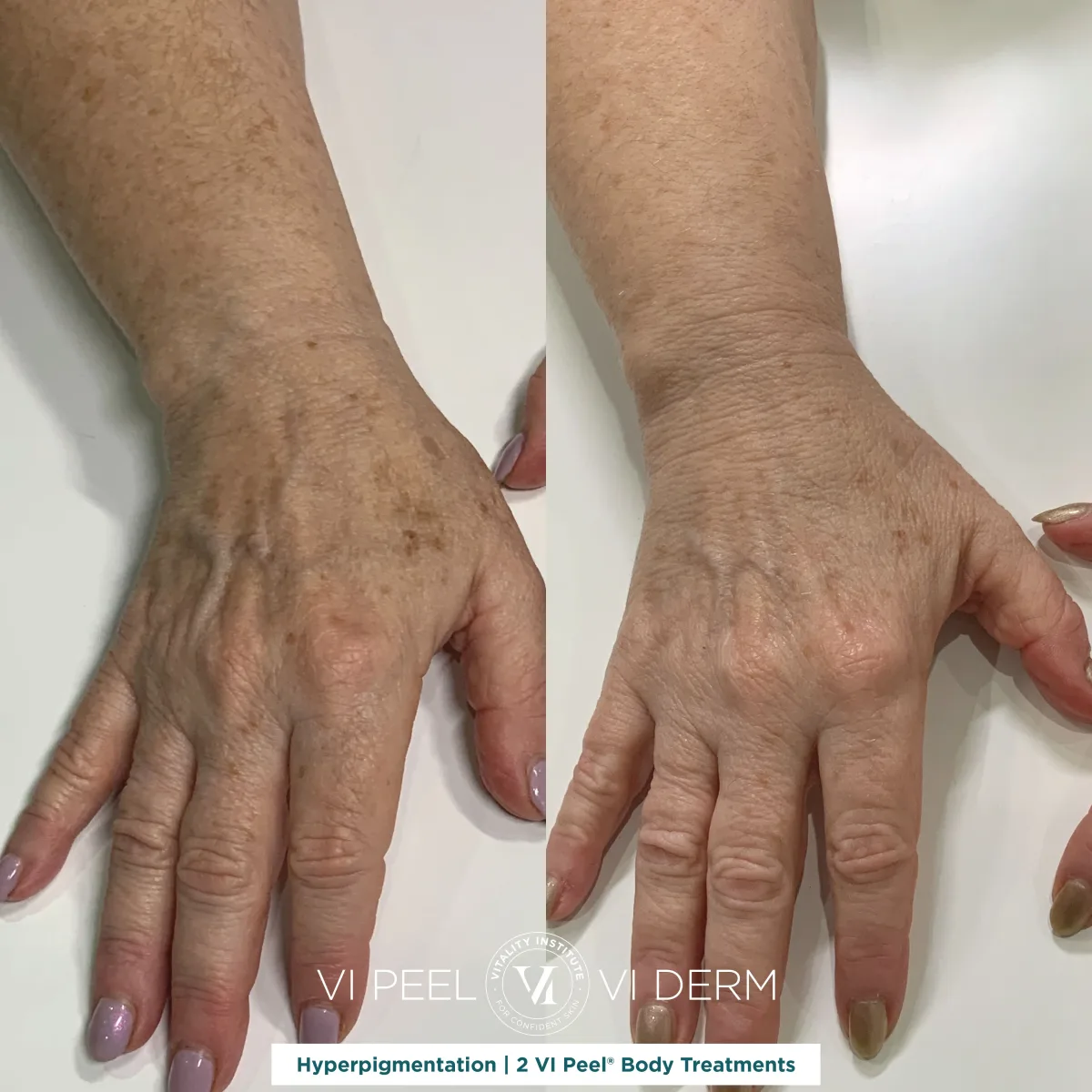 Hand and arm age spots and sun damage before and after 2 VI Peel Body treatments