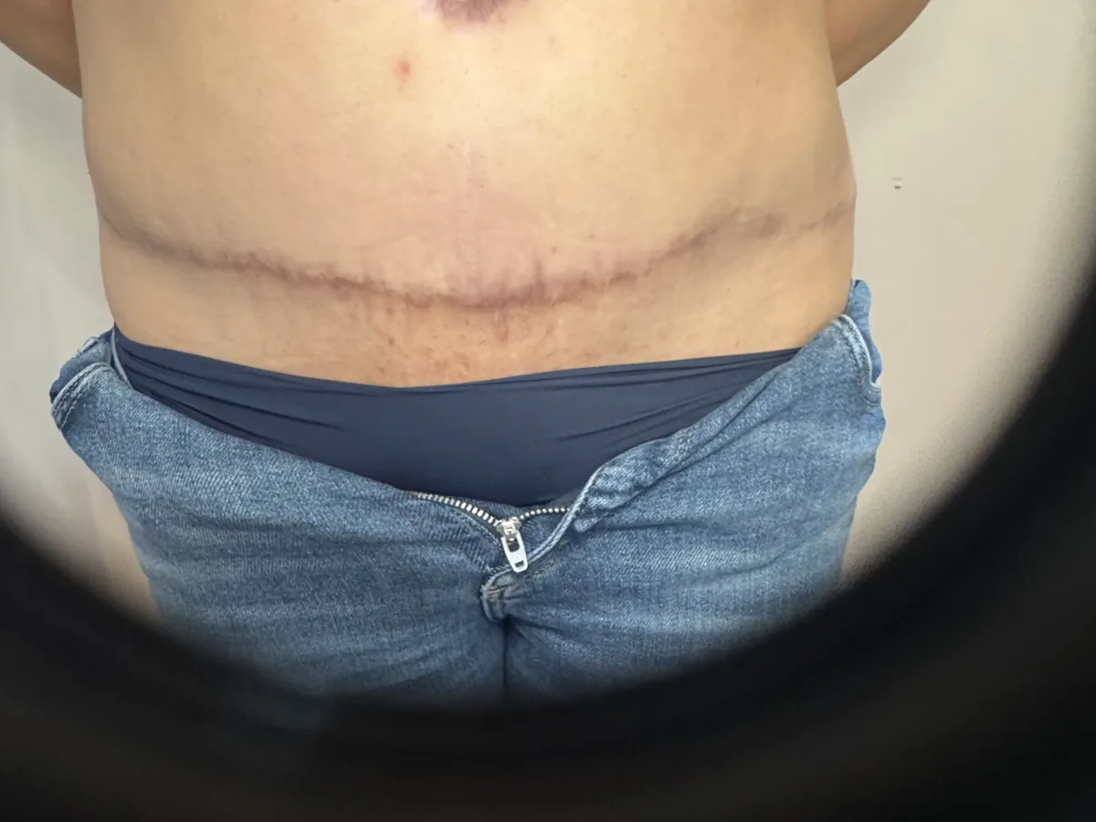 Abdomen with c-section scar before revision
