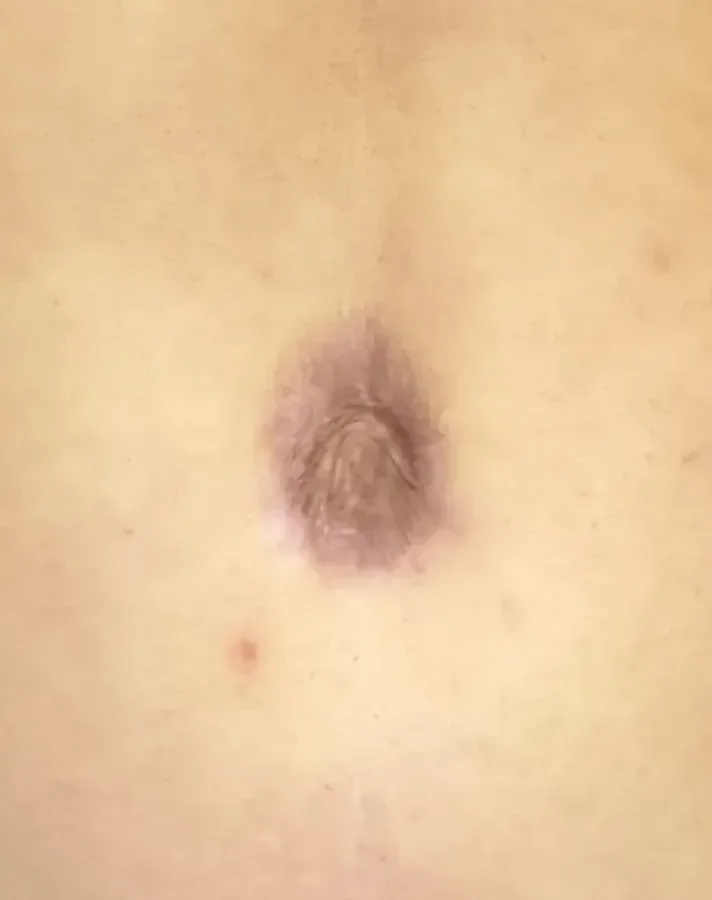 Abdomen with c-section scar before revision