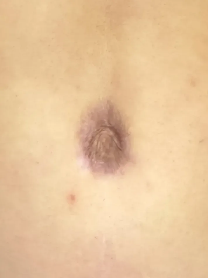 Abdomen with c-section scar before revision