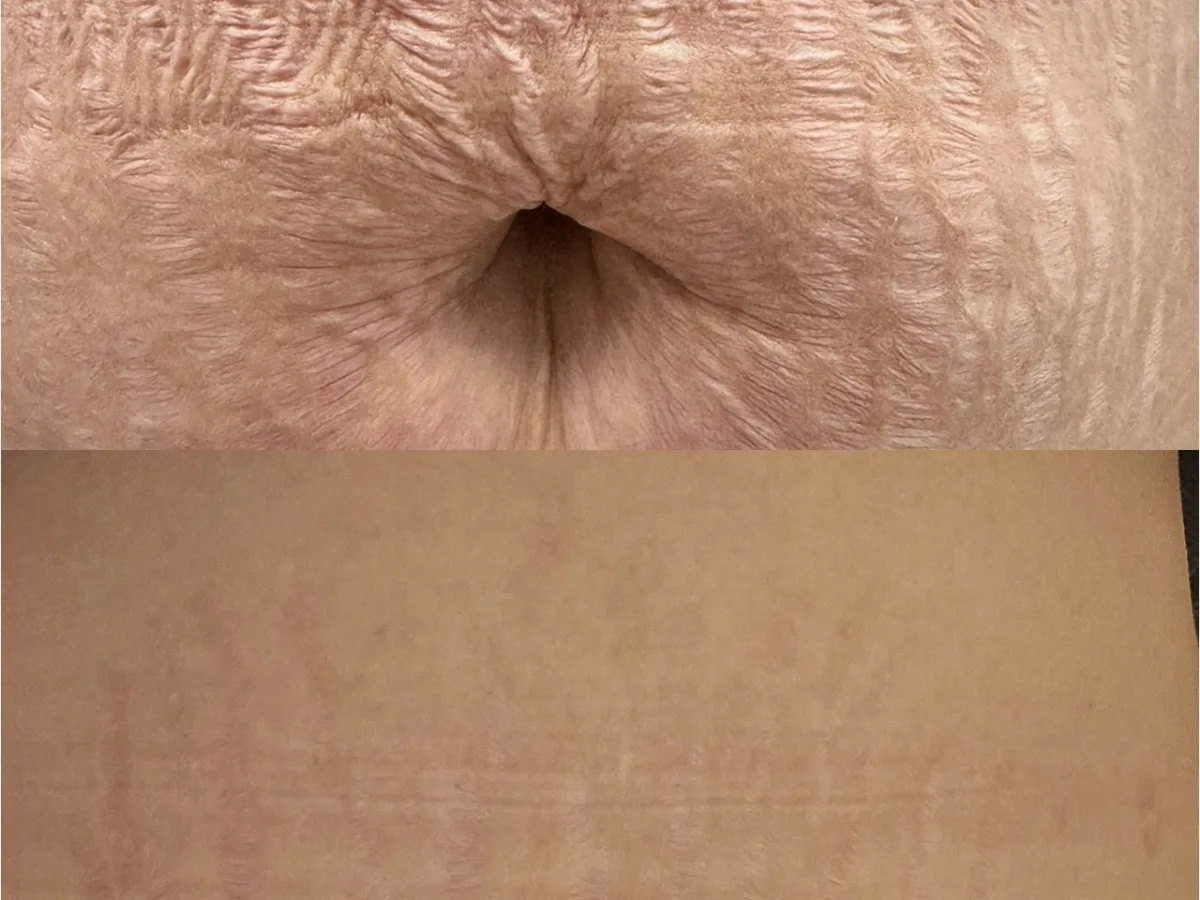 Abdomen before and after stretch mark revision — dramatic reduction in visibility