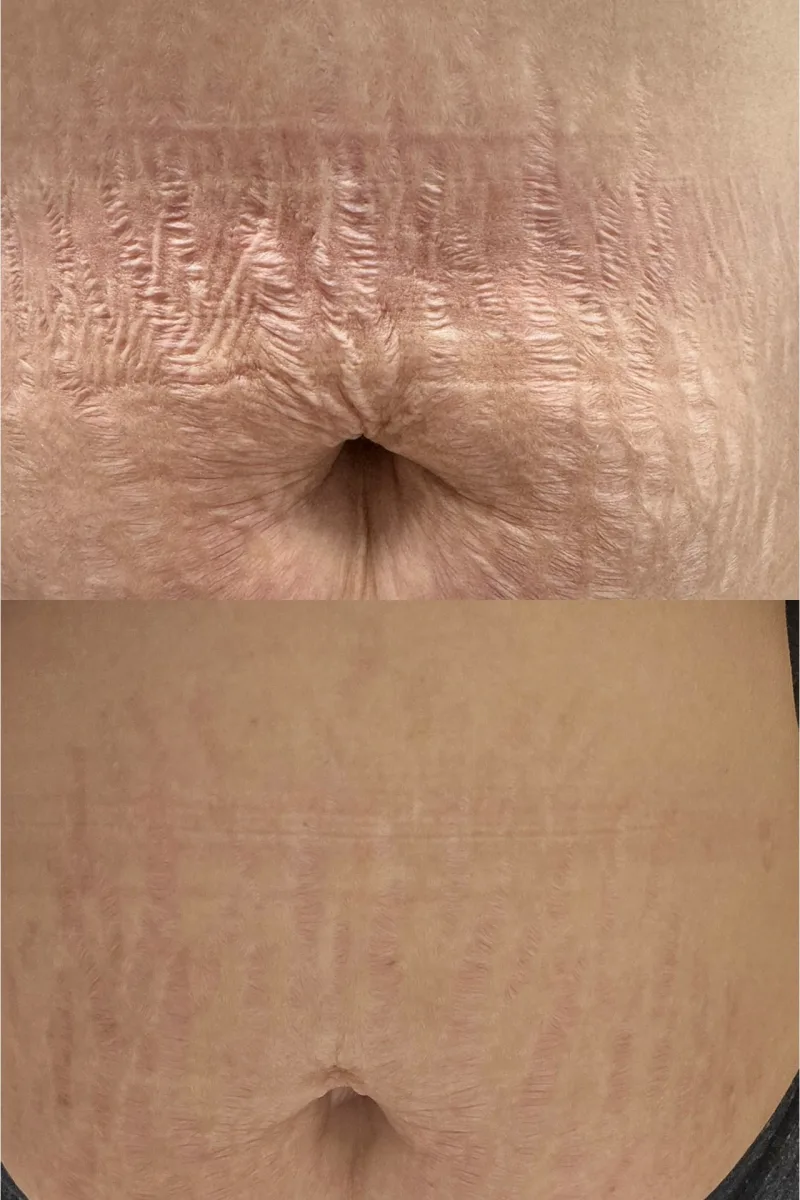 Before and after postpartum stretch mark revision on the abdomen