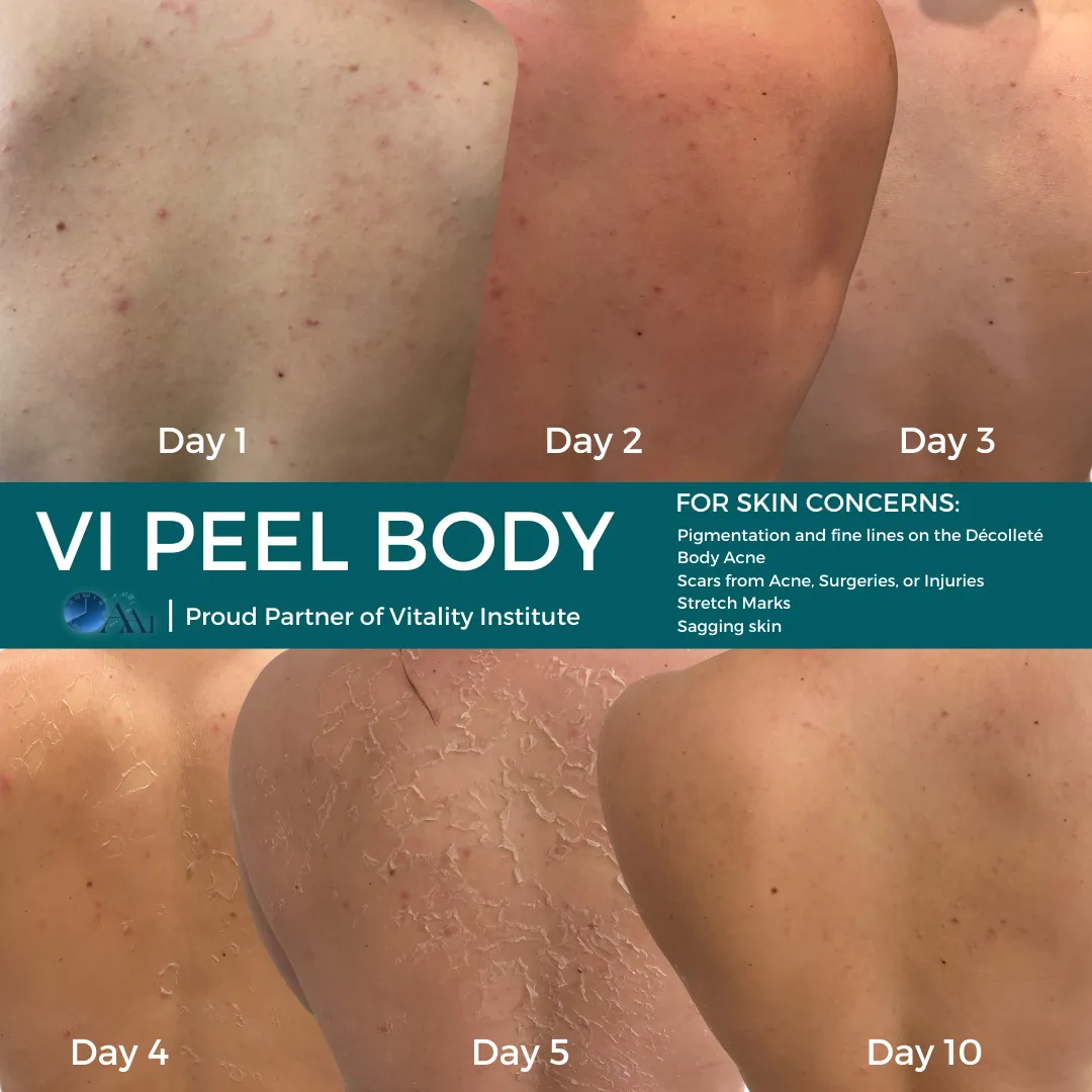 VI Peel Body day 1 through day 10 back acne progression — Ink and Restore