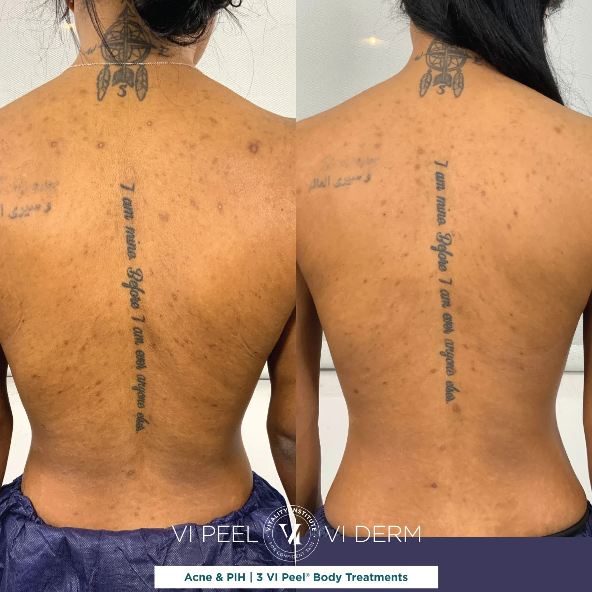 Back acne and PIH on medium-deep skin tone before and after 3 VI Peel Body treatments